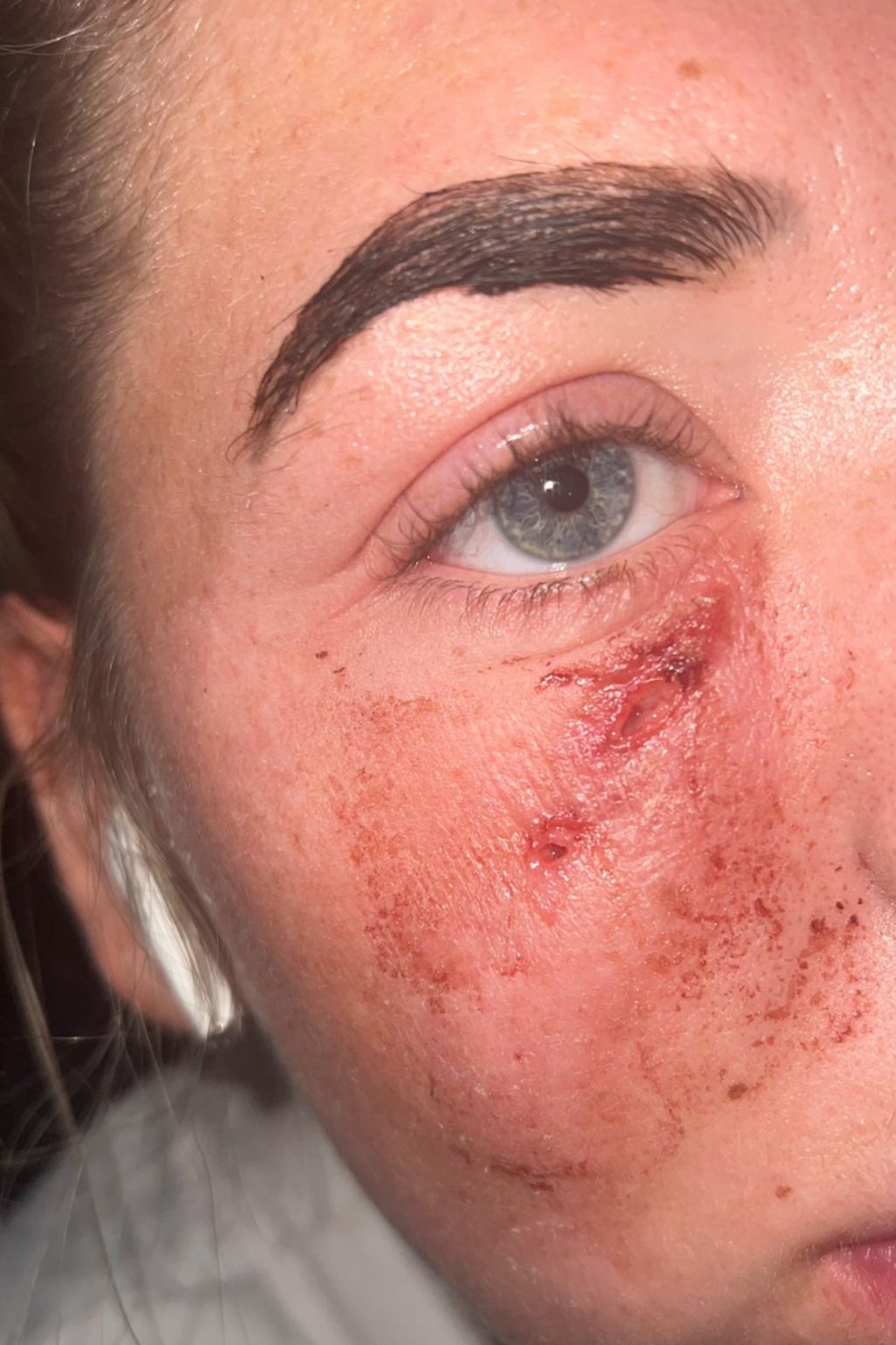 Lauren Bateman’s scars after her filler was drained from under her eye