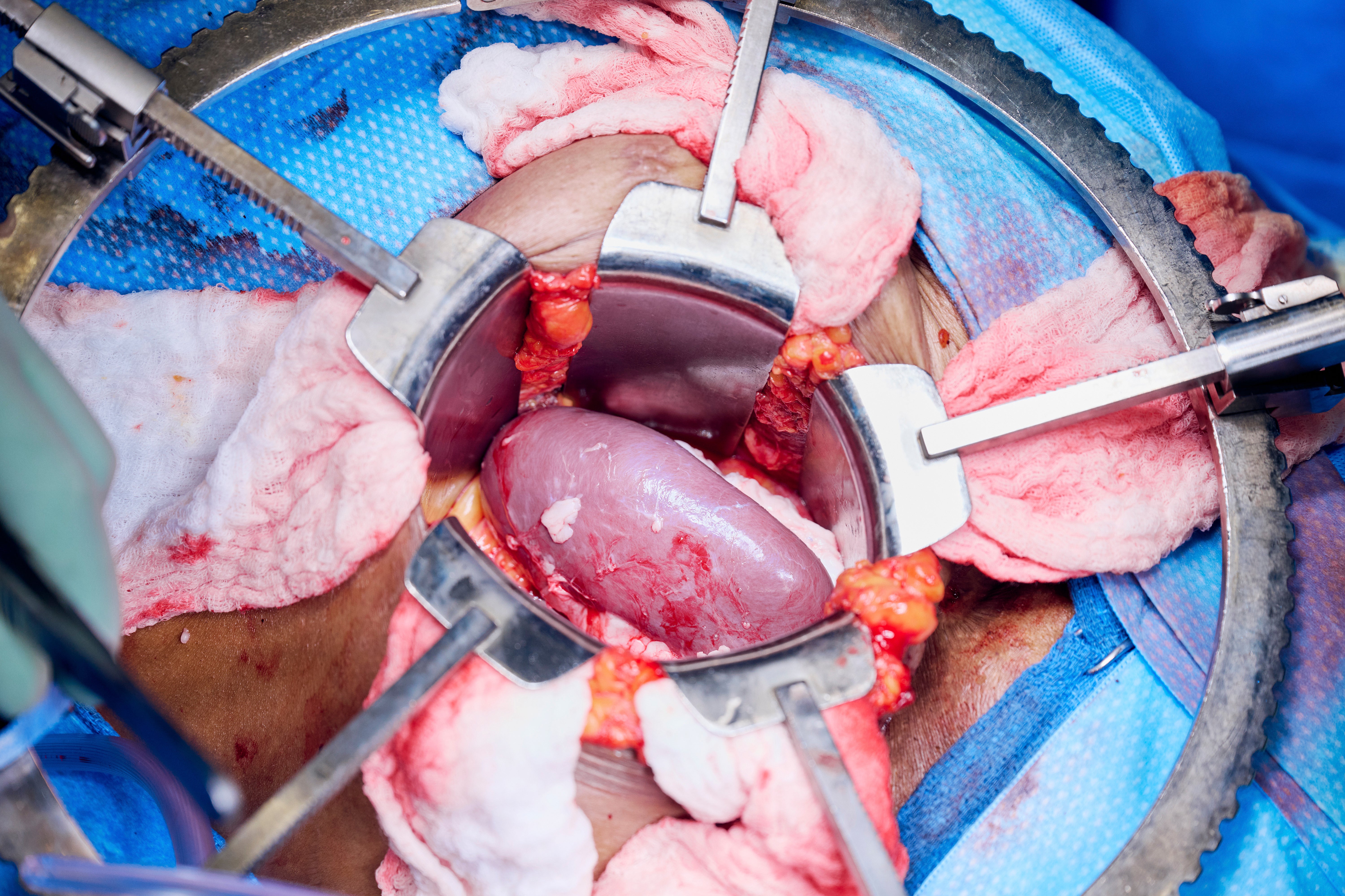 The gene-edited pig kidney is seen moments after blood vessels are reattached. More than 100,000 people are on the US transplant list