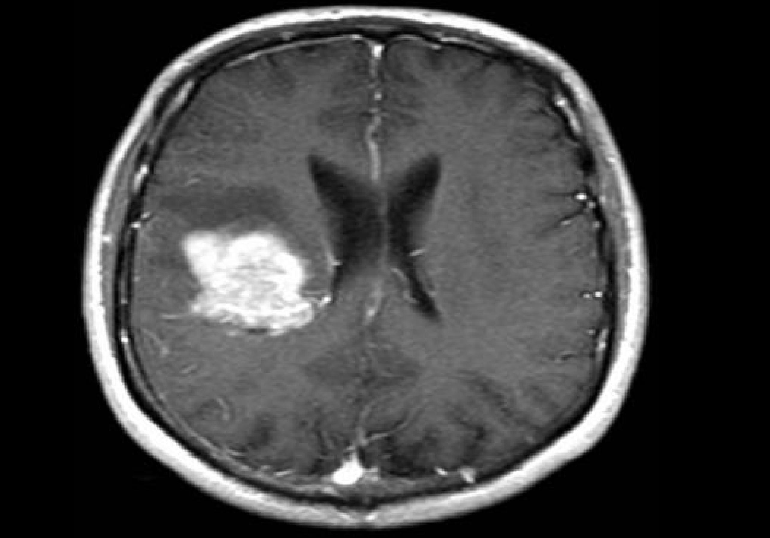 A brain scan shows the white mass of a solid tumour on the left