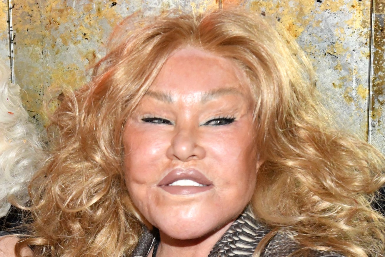 Jocelyn Wildenstein suffered from pulmonary embolism caused by phlebitis at the time of her death