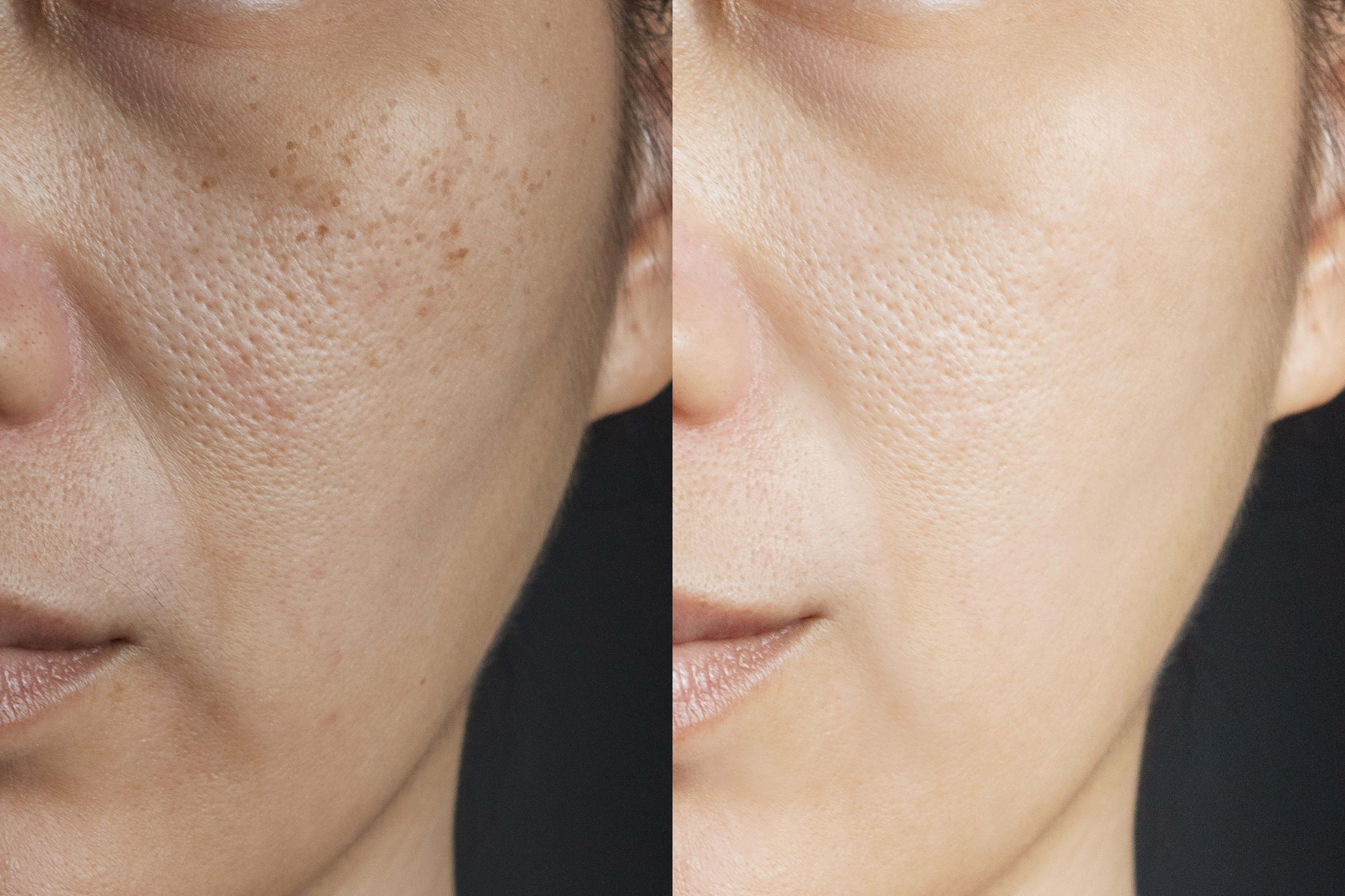 Two pictures compare effect Before and After treatment. skin with problems of freckles , pore , dull skin and wrinkles before and after treatment