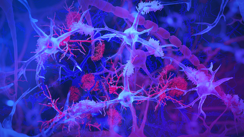 <p>Brain’s immune cells, or microglia (light blue/purple) shown interacting with amyloid plaques (red) linked to Alzheimer’s disease</p>