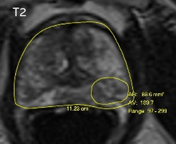 An MRI image showing only one tumour found. (Heriot-Watt/PA)