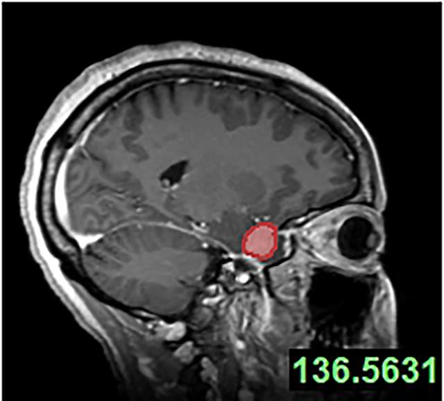 <p>Undated handout image issued by Leeds Teaching Hospitals NHS Trust of an MRI scan used by surgeons to visualise Ruvimbo Kaviya's tumour, who became the first person in the UK to receive groundbreaking surgery to remove a tumour through her eye socket.</p>