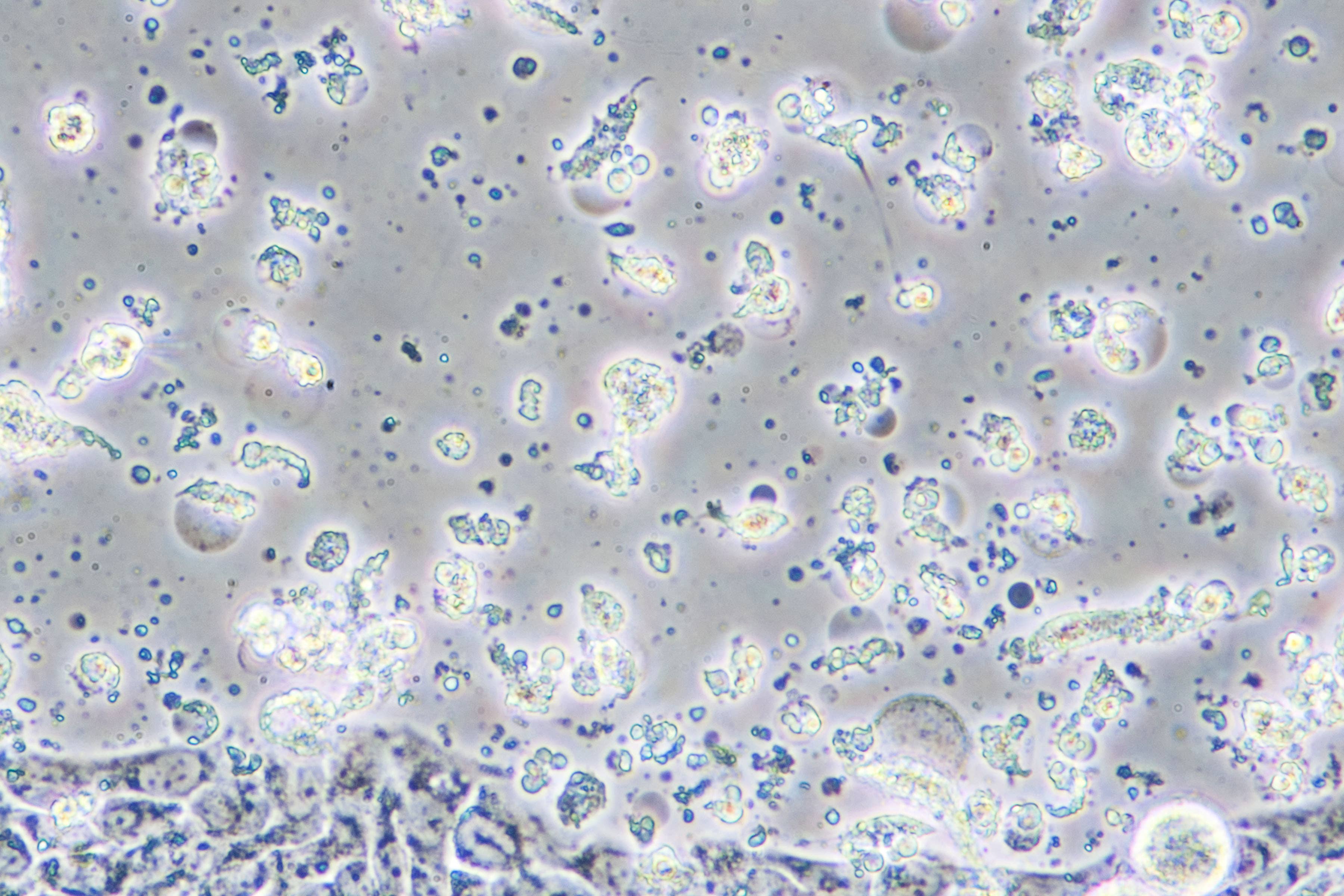 Microscope view of bowel cancer cells in tissue culture