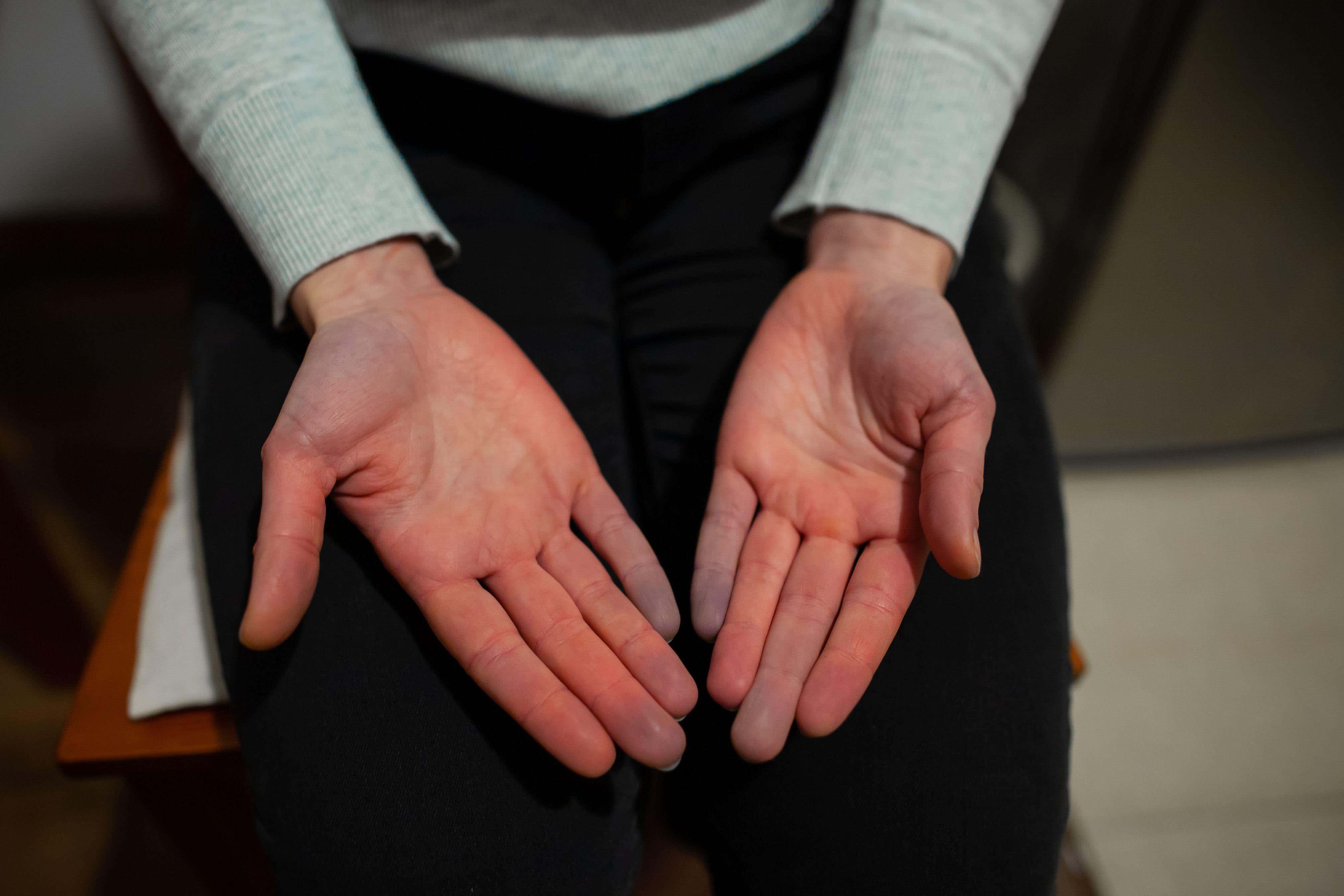 Raynaud’s is a common phenomenon that affects up to 10 million people in the UK, according to SRUK (Alamy/PA)