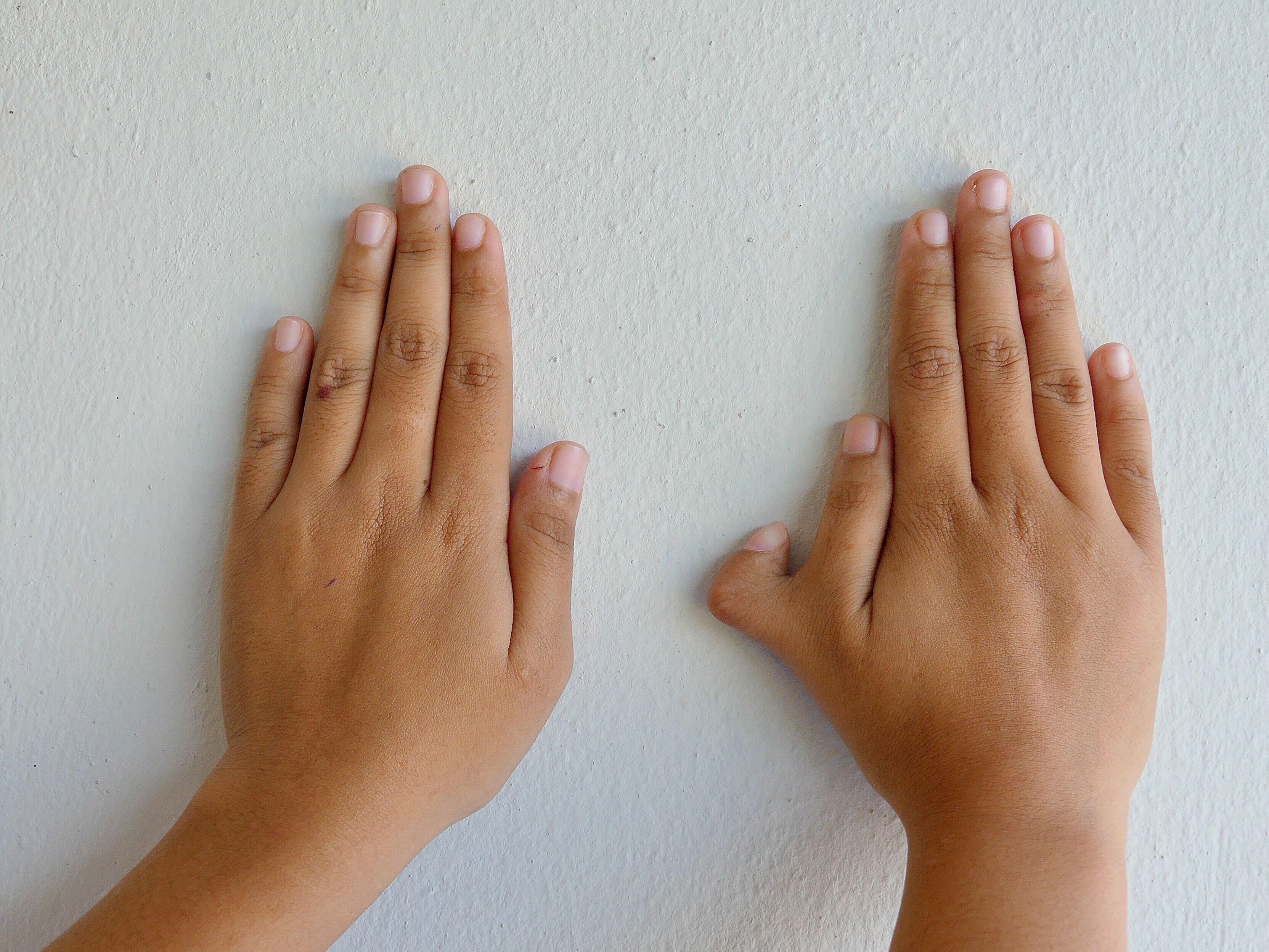 Photo of woman with an extra fingers on her right hand, caused by Polydactyly