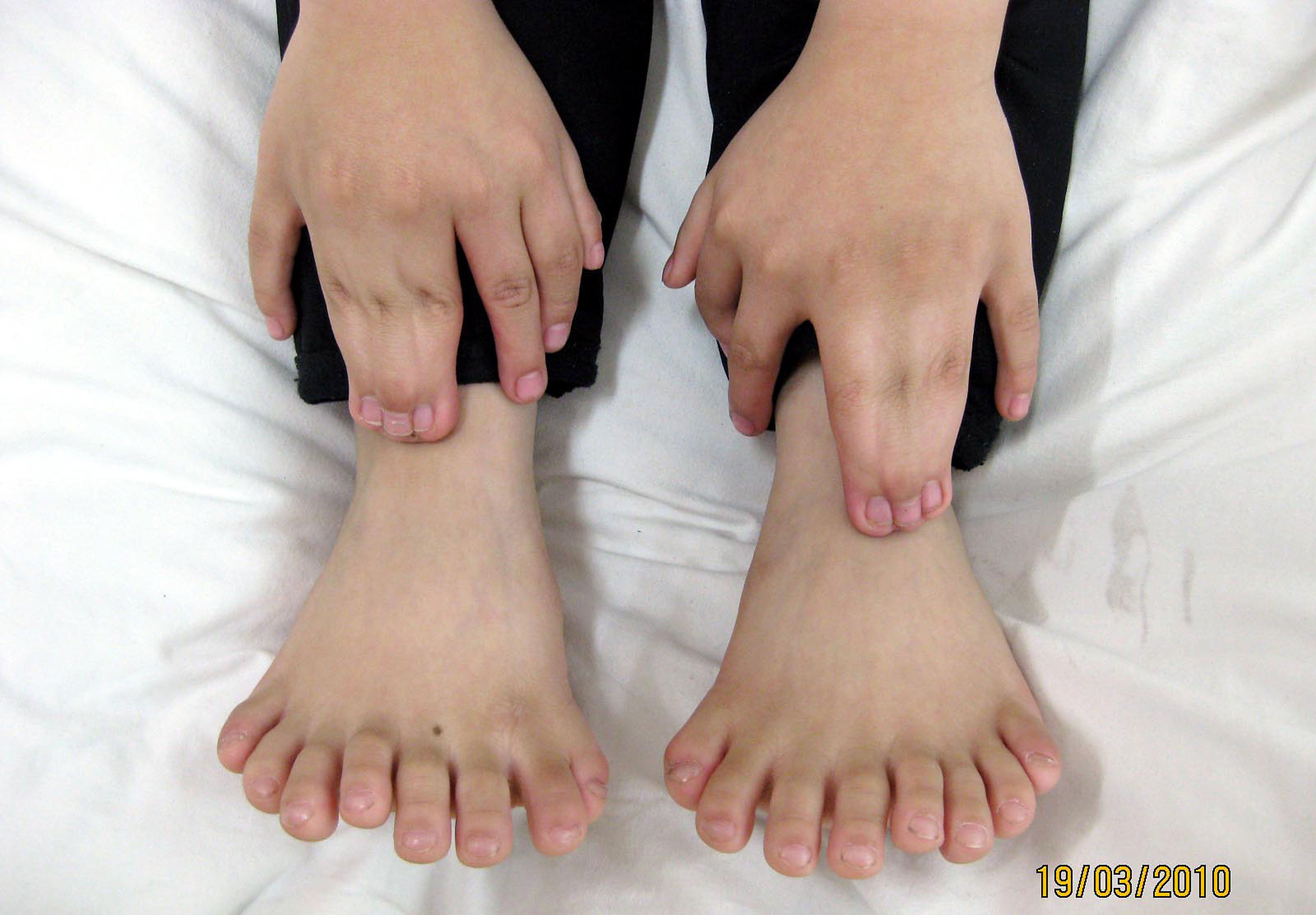 A six-year-old boy with Polydactyly on his hands and feet