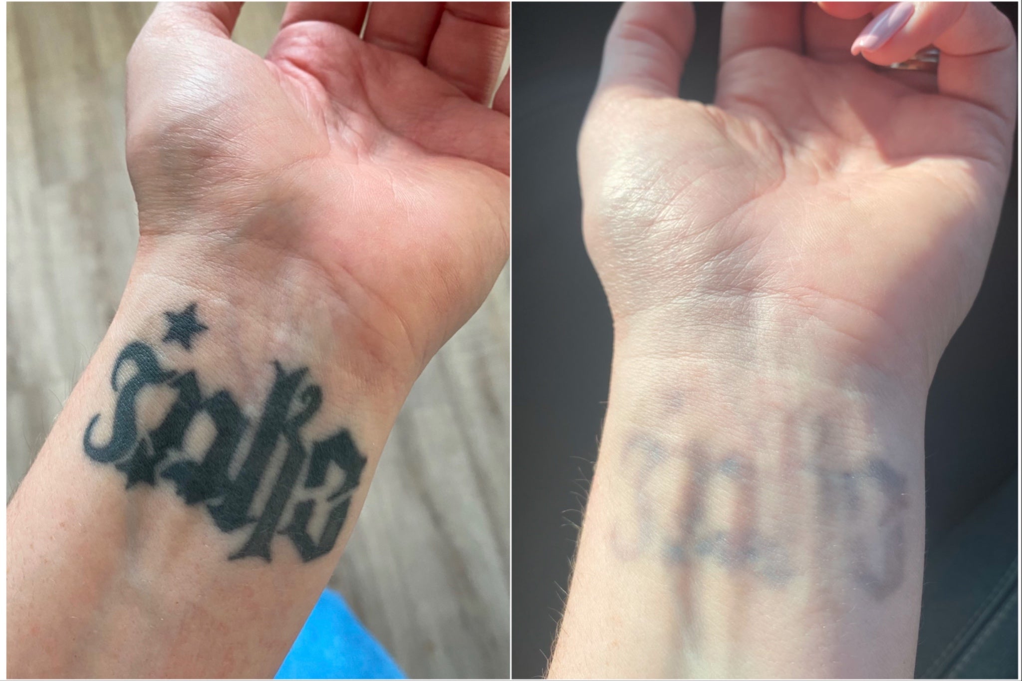 Edwards’ ambigram tattoo before and after multiple removal sessions