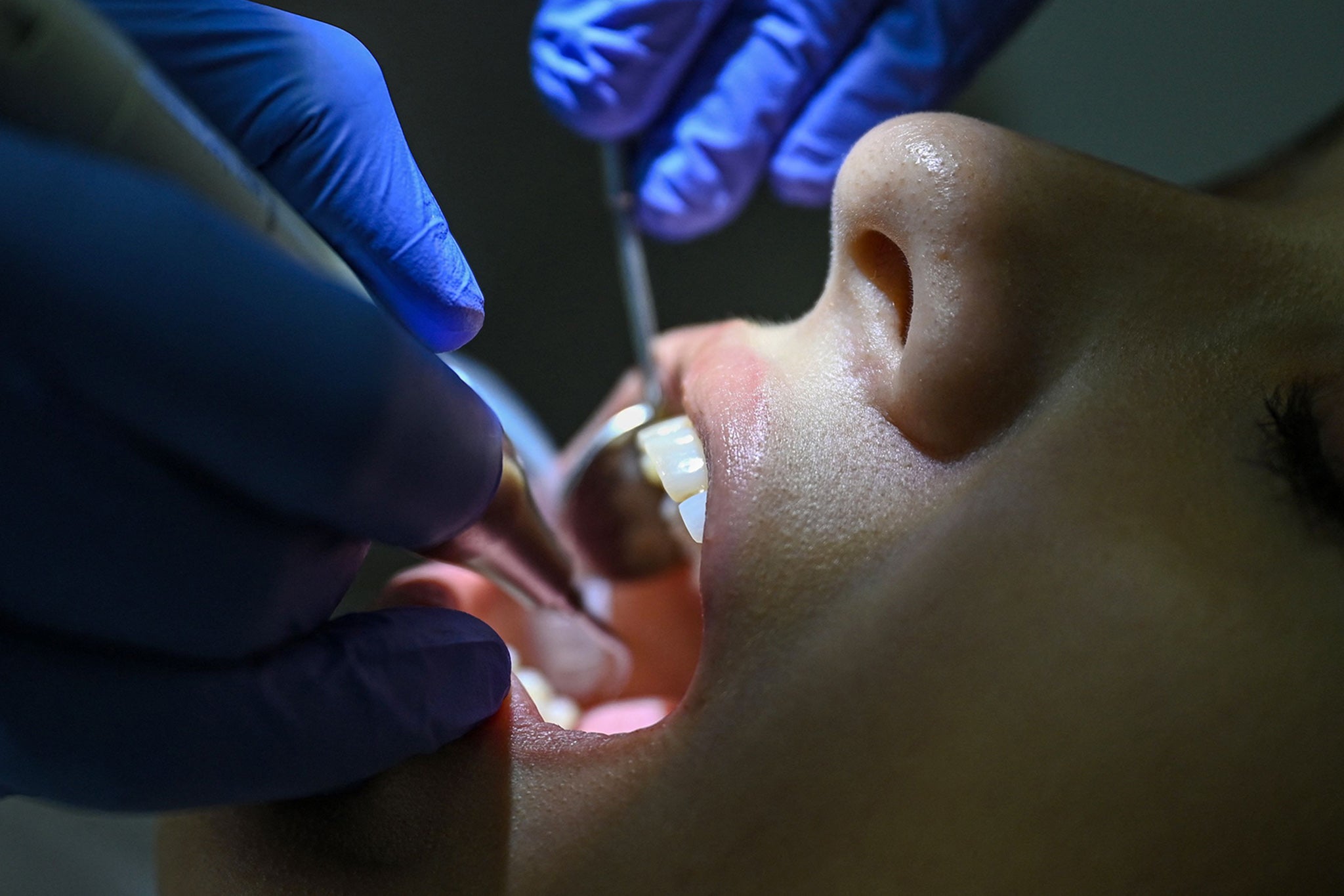 Research is limited on the connection between the medication and oral health