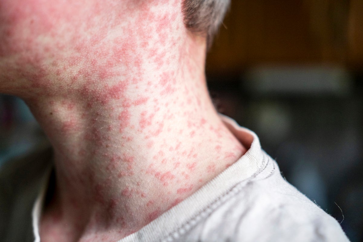 The measles symptoms to look out for as cases rise across UK The measles symptoms to look out for as cases rise across UK