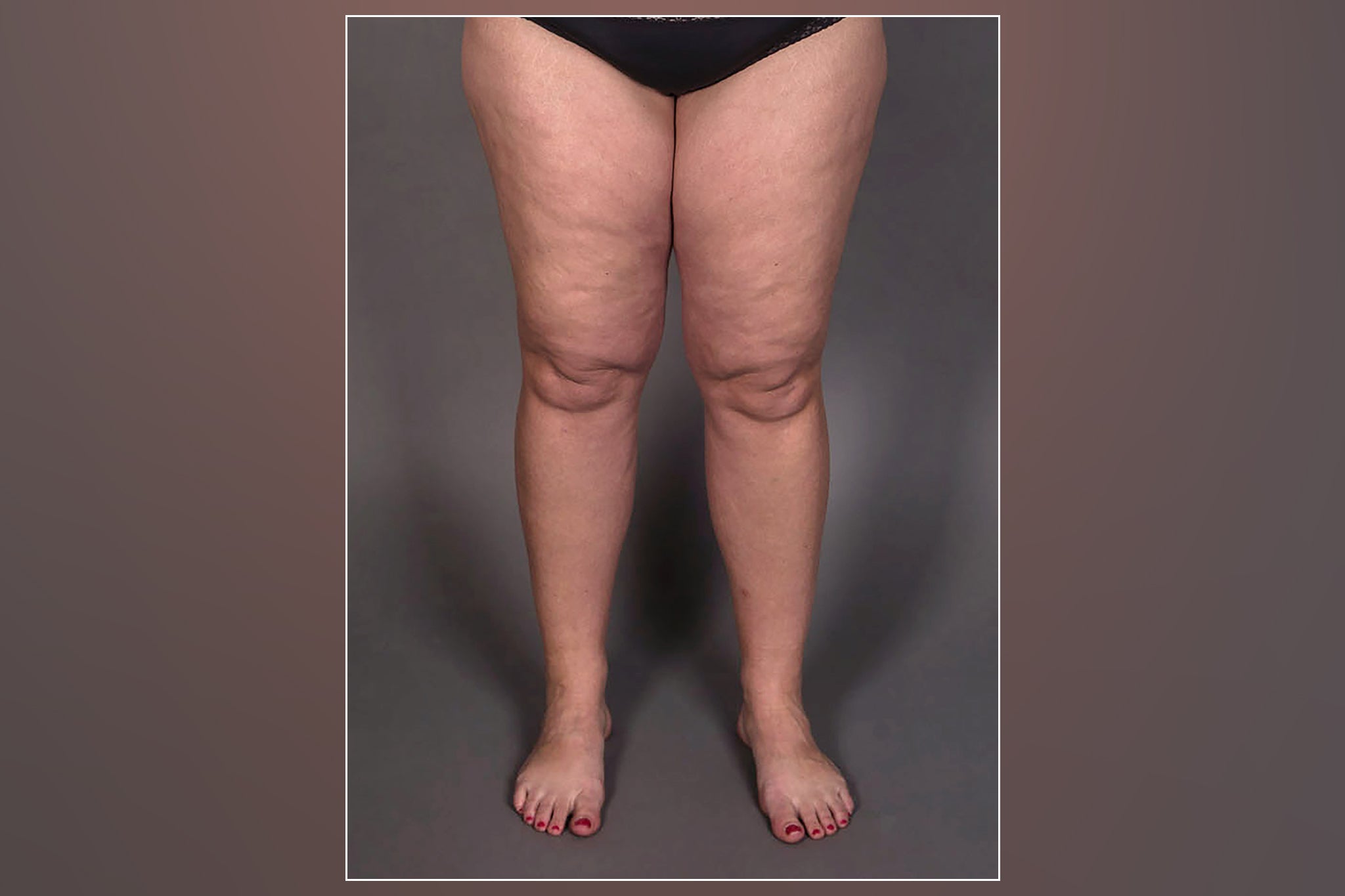 Lipoedema can vary in severity