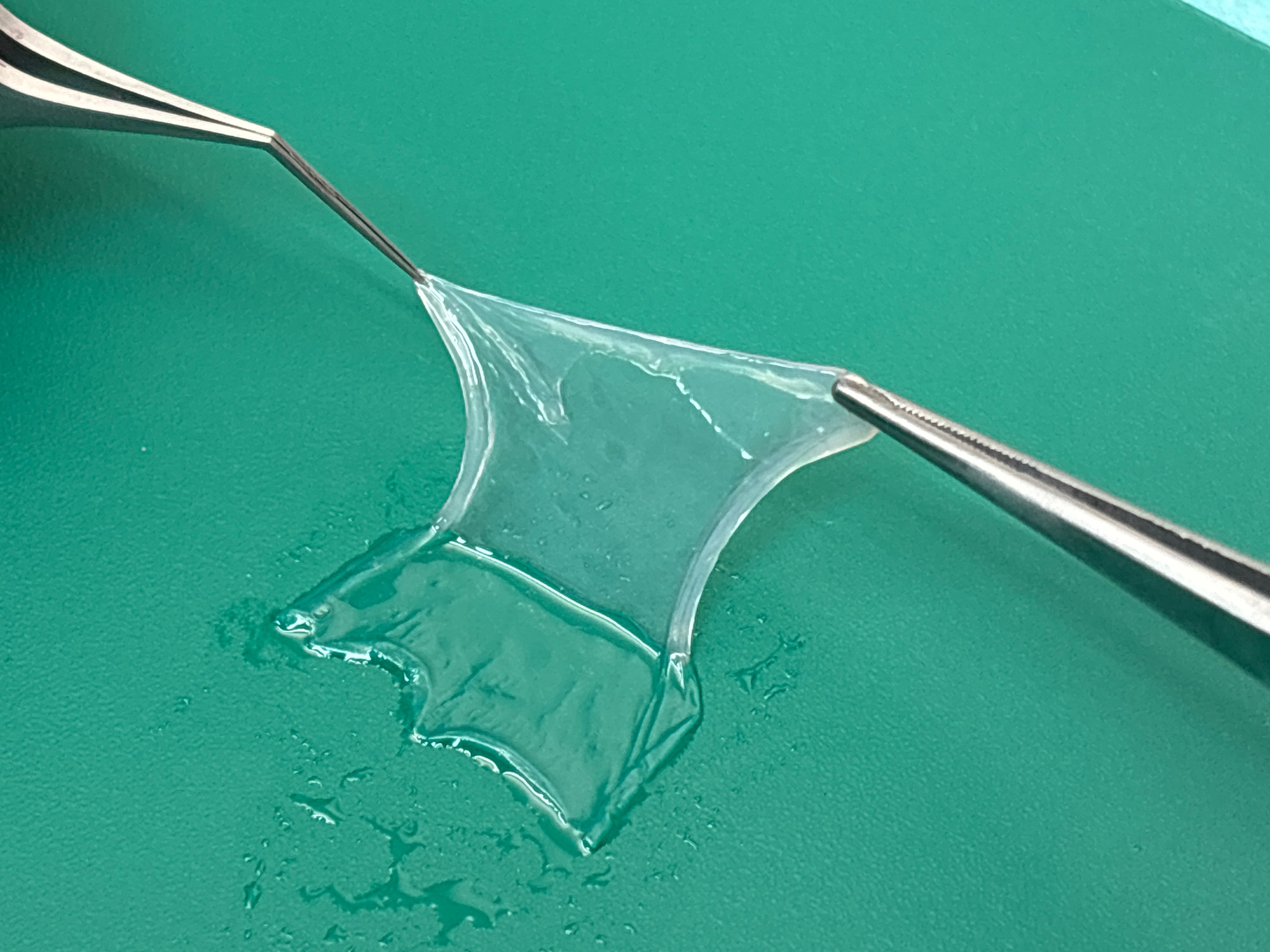 An amnion graft, created by taking tissue from the inner lining of a donated placenta