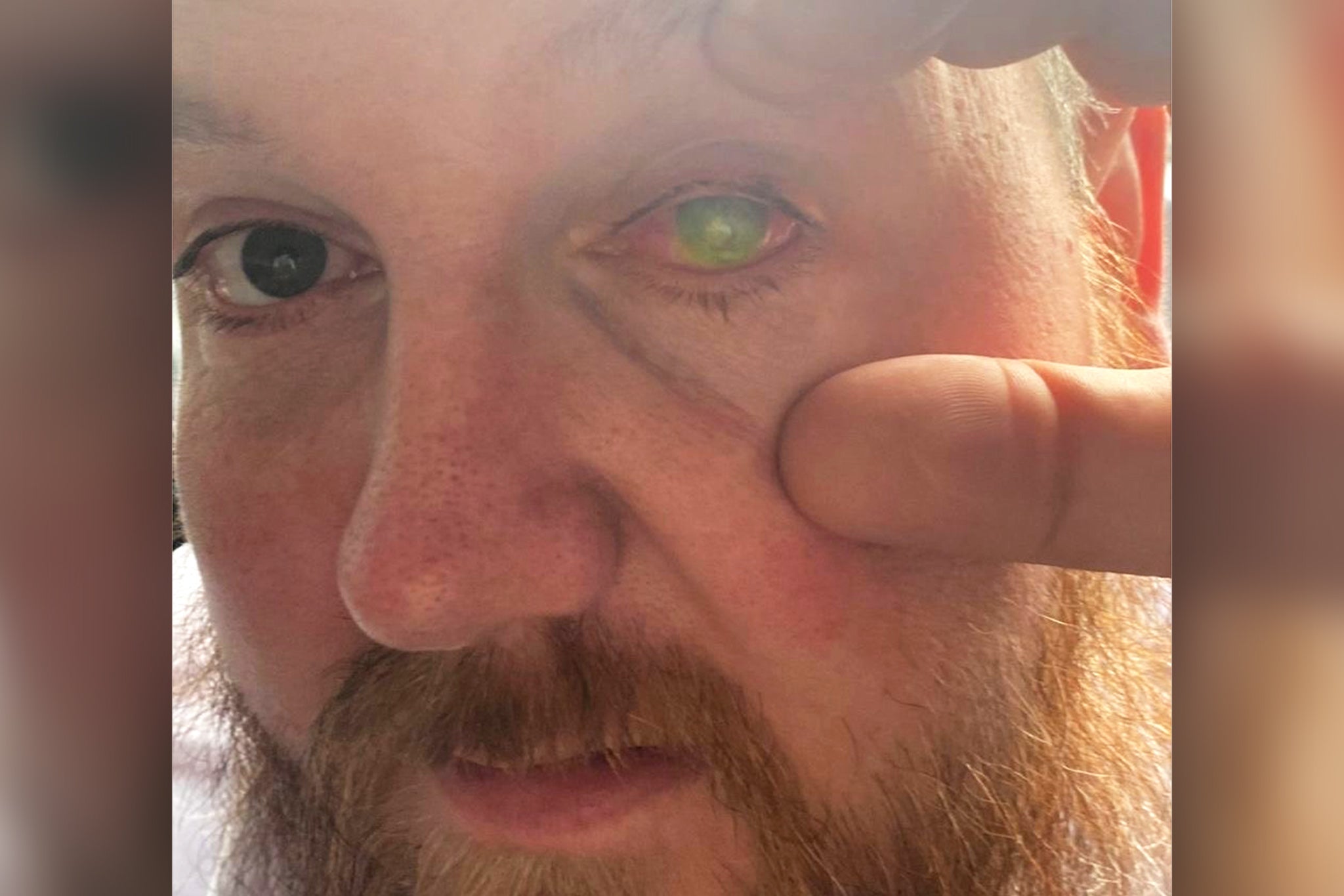 Paul Laskey says his vision was saved by a donated placenta