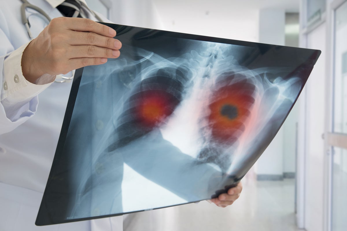 The nine small health issues that could be an early sign of lung cancer The nine small health issues that could be an early sign of lung cancer