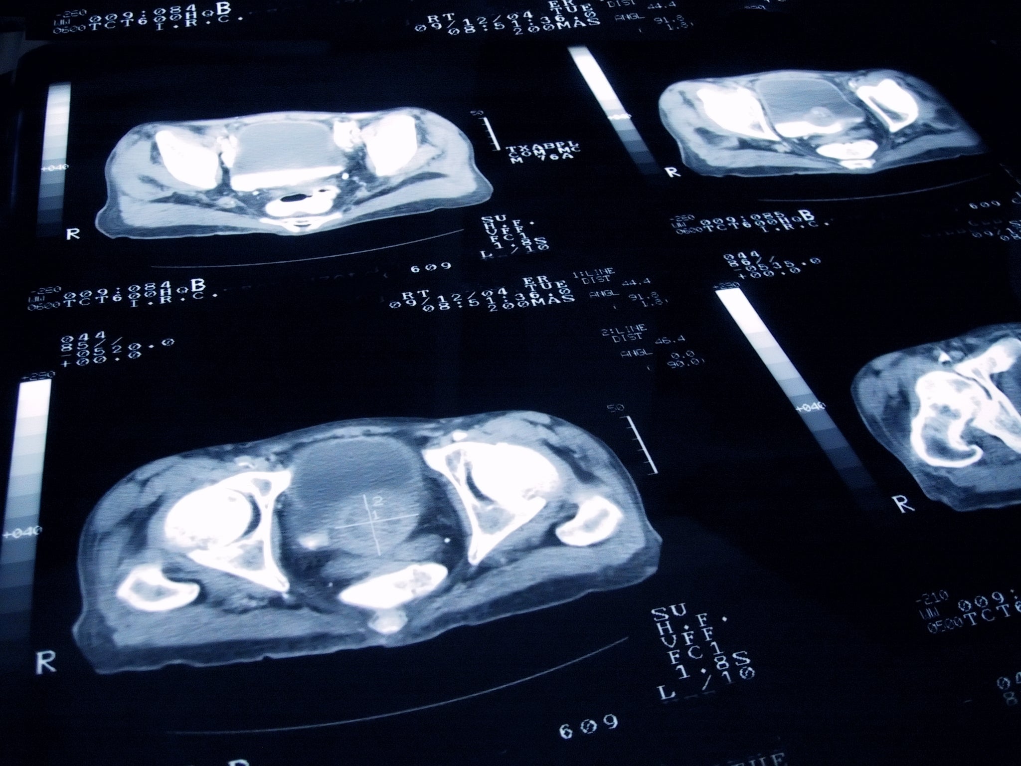 A prostate cancer screening