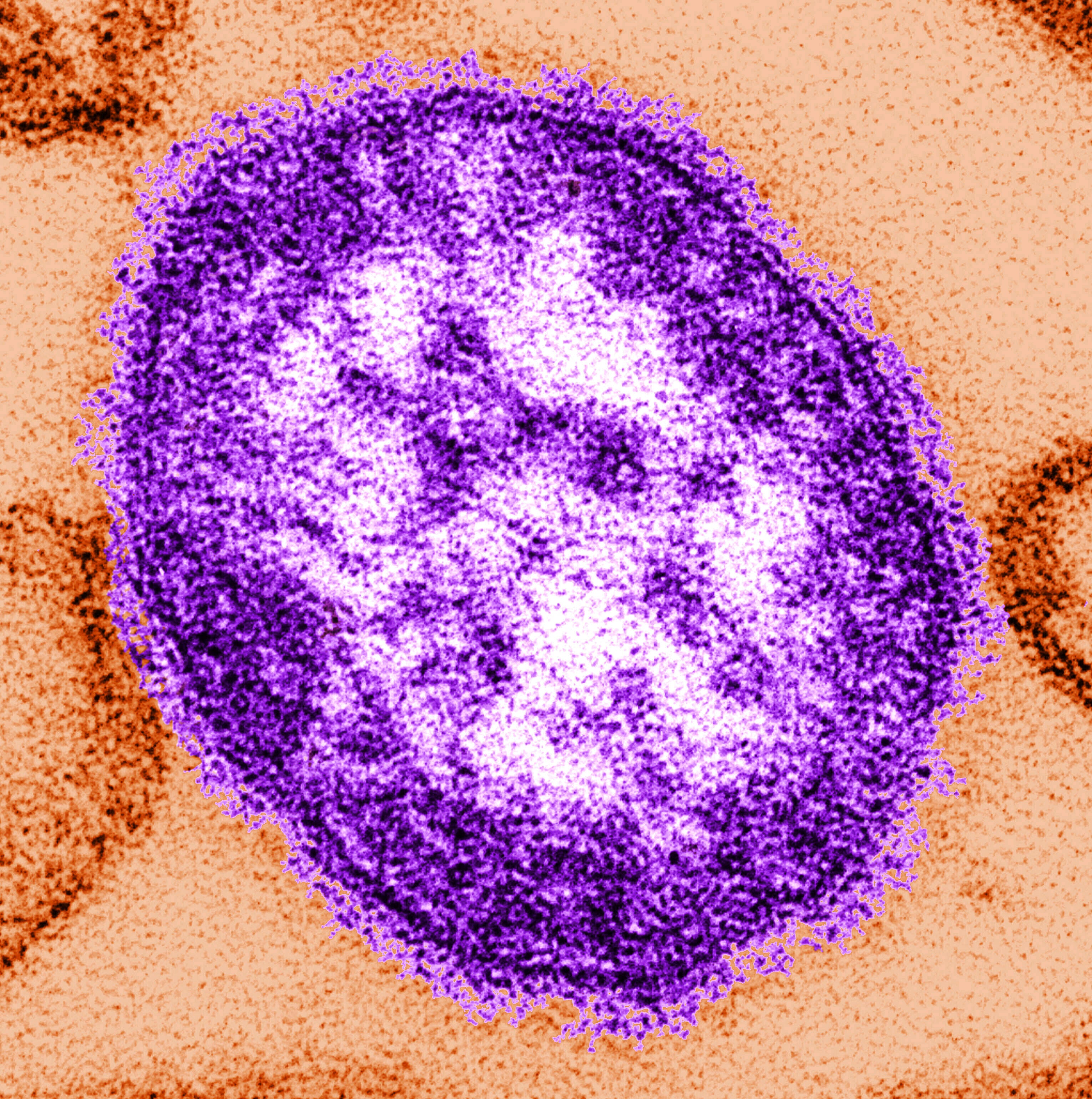 An outbreak of the deadly measles virus has grown in West Texas. There are now nearly 150 infections confirmed in the state