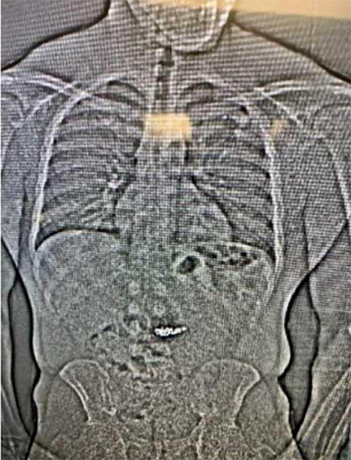 Florida cops ‘recover’ $770K worth of diamonds weeks after a suspect swallowed them during traffic stop