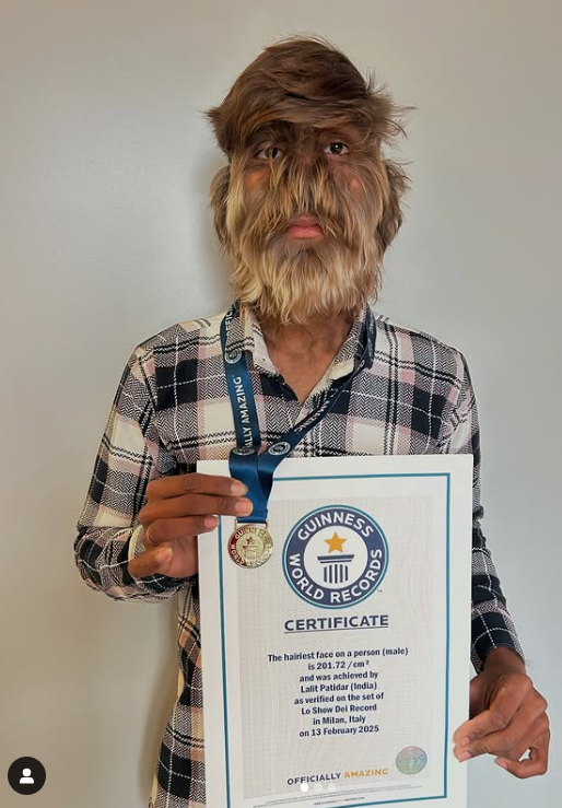 Lalit Patidar from Madhya Pradesh in India has a rare condition called 'werewolf syndrome'
