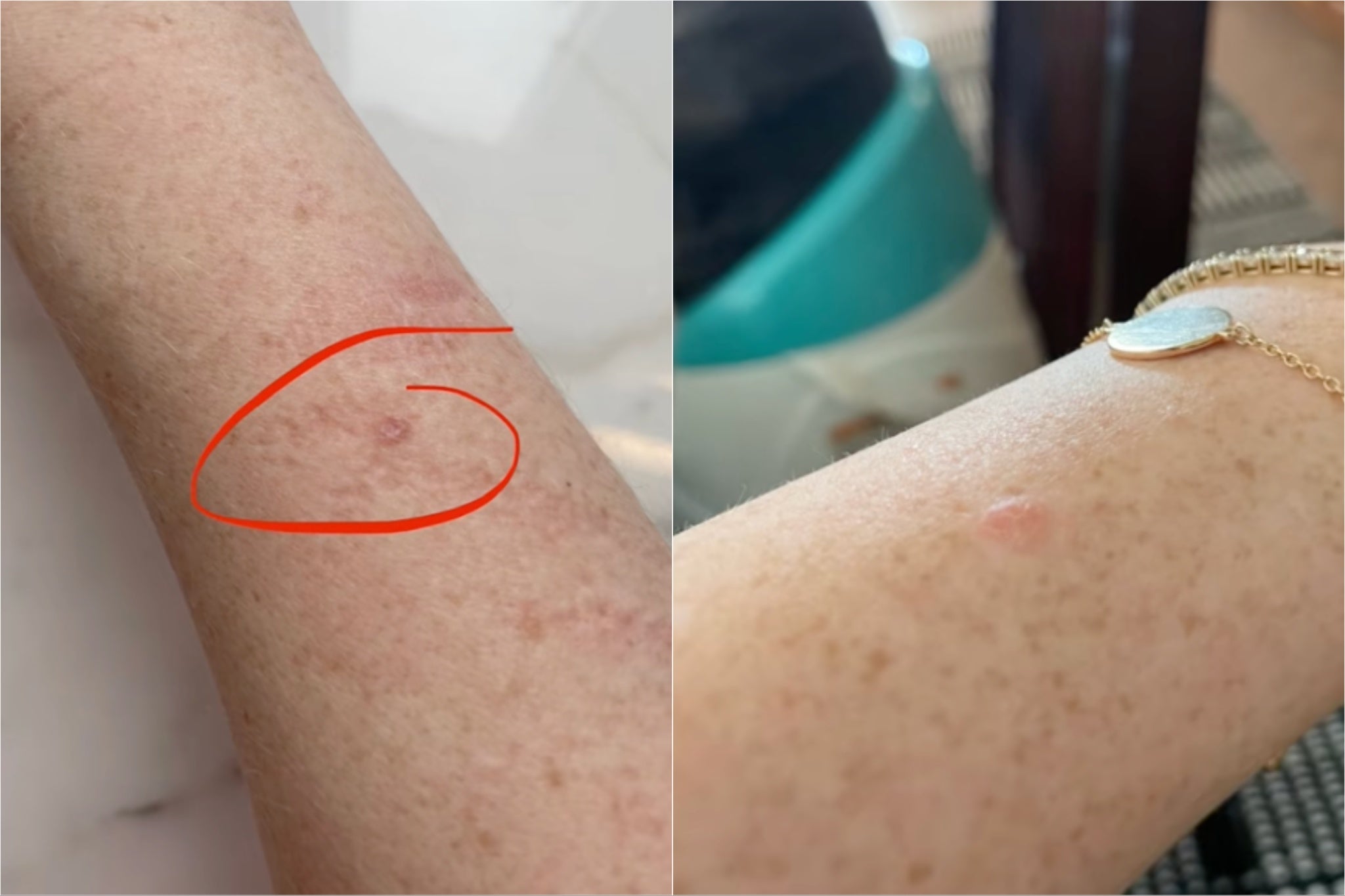 A picture of Katherine Ryan’s cancerous mole, taken in 2022 (right) and more recently (left)