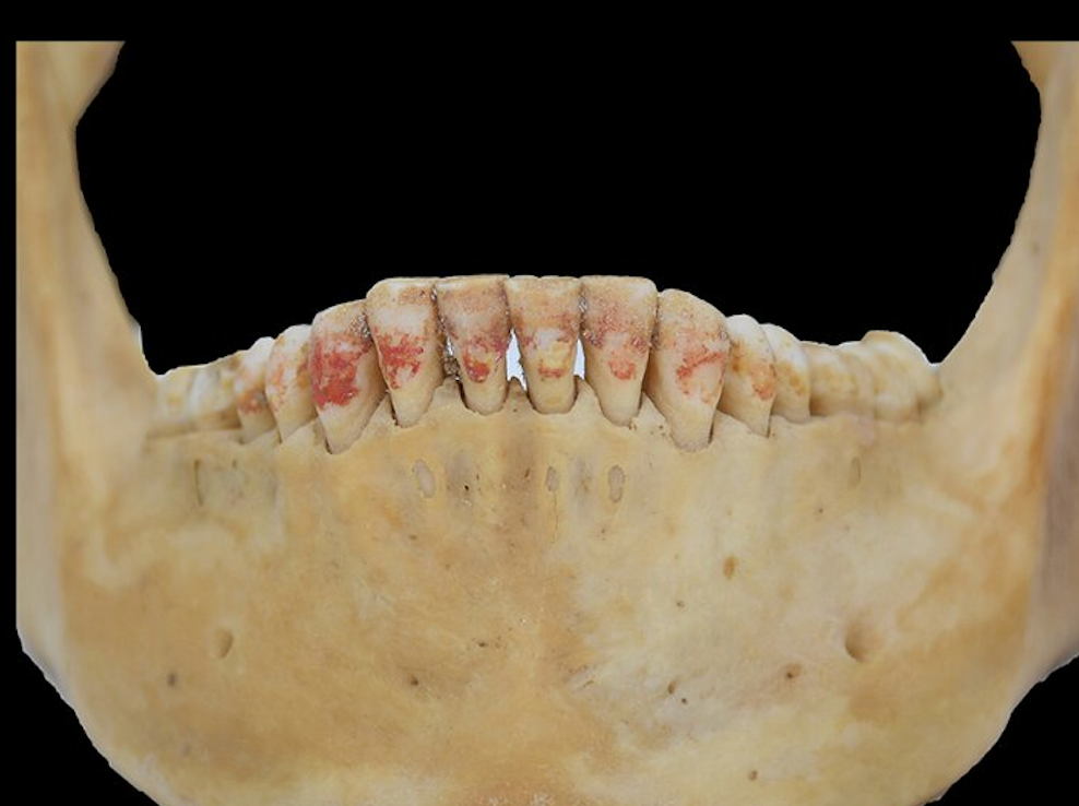 Red staining on woman's teeth