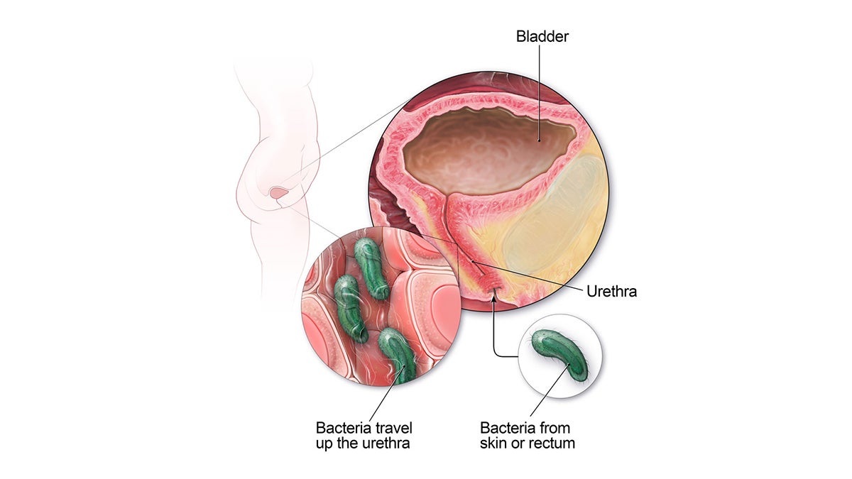 A graphic from the Centers for Disease Control and Prevention shows the female urinary tract. Bacteria from the skin or rectum can travel up the urethra and cause a bladder infection