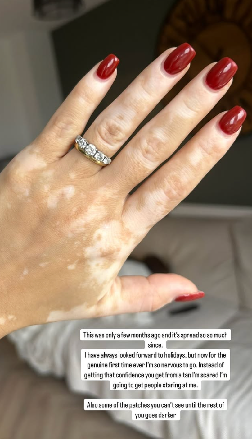 Georgia May Foote shares a picture of the vitiligo on her hand on Instagram