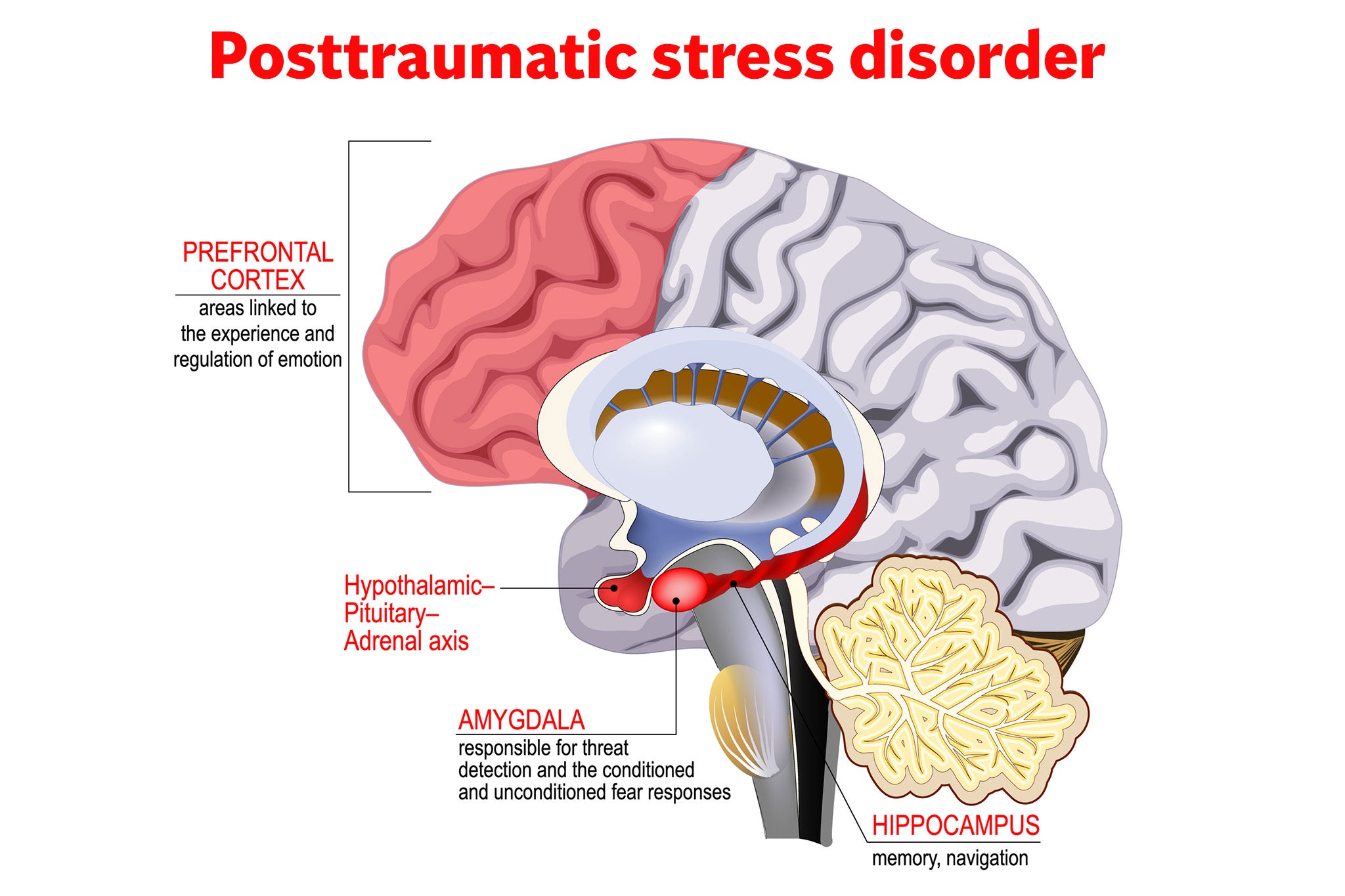 PTSD is a vicious circle of glitching between the brain’s memory bank, which controls threat responses, and the front of the brain that puts data into rational context