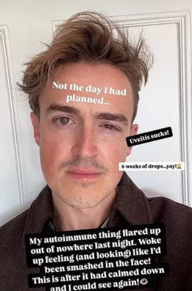 The McFly singer lives with a rare auto -immune condition called uveitis, an auto -immune condition that causes inflammation in the eye