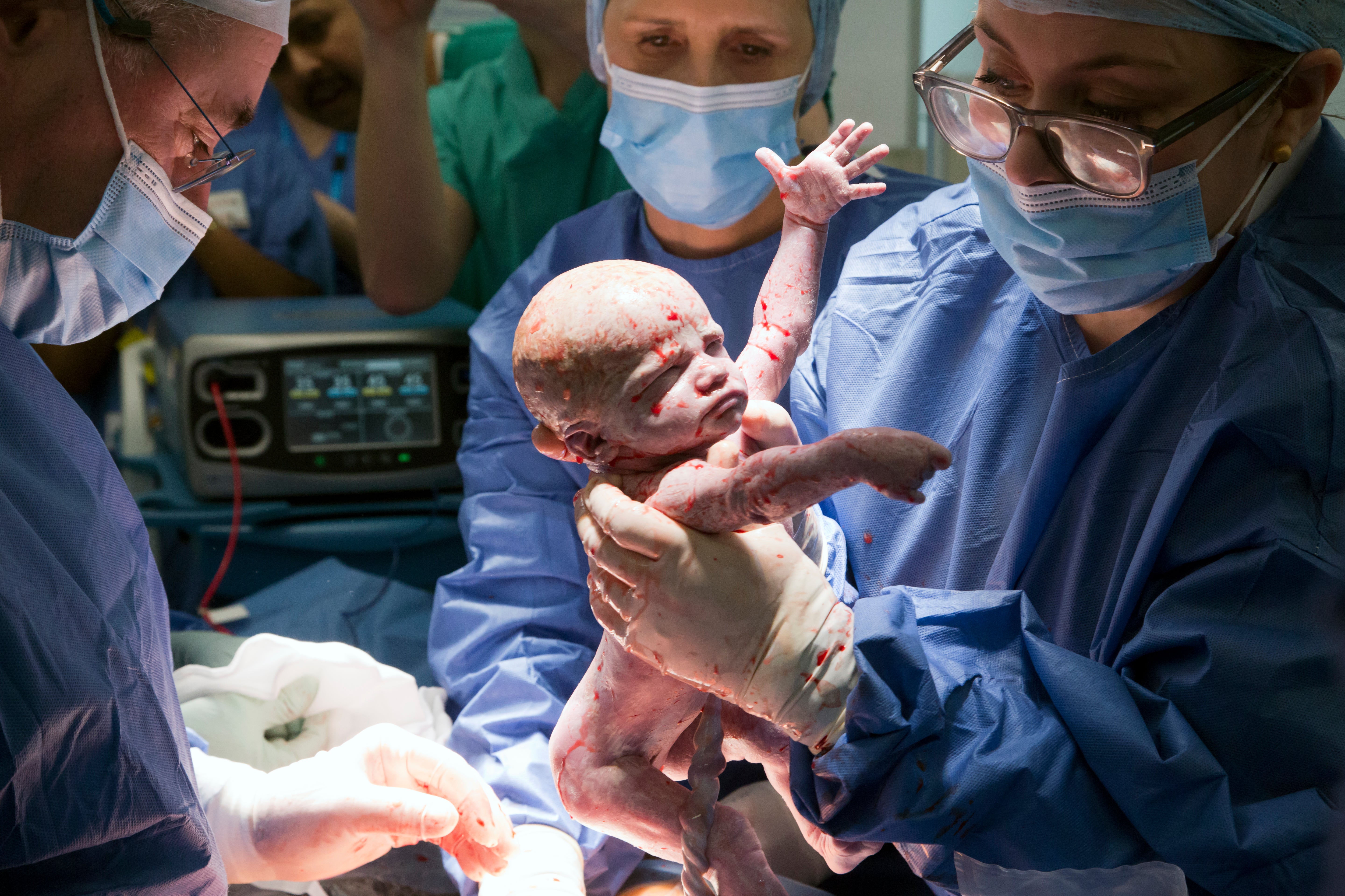 The surgeons delivered baby Amy in London in February following the transplant in 2023