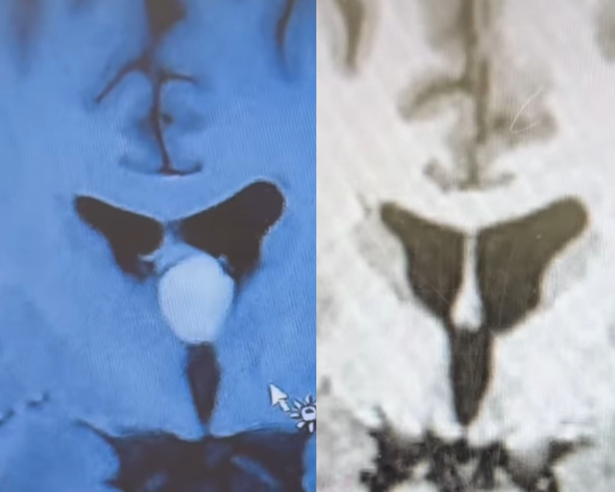 McCall’s MRI brain scans showing the tumour before and after surgery