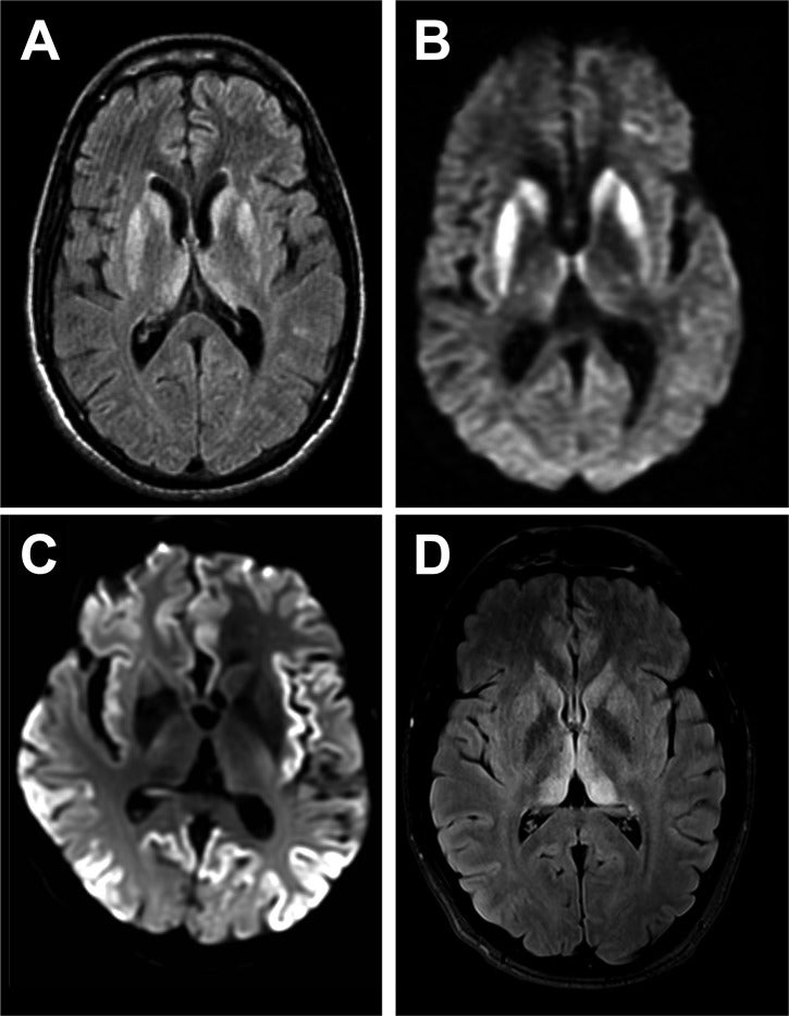 MRI scan shows typical features of Creutzfeldt–Jakob disease