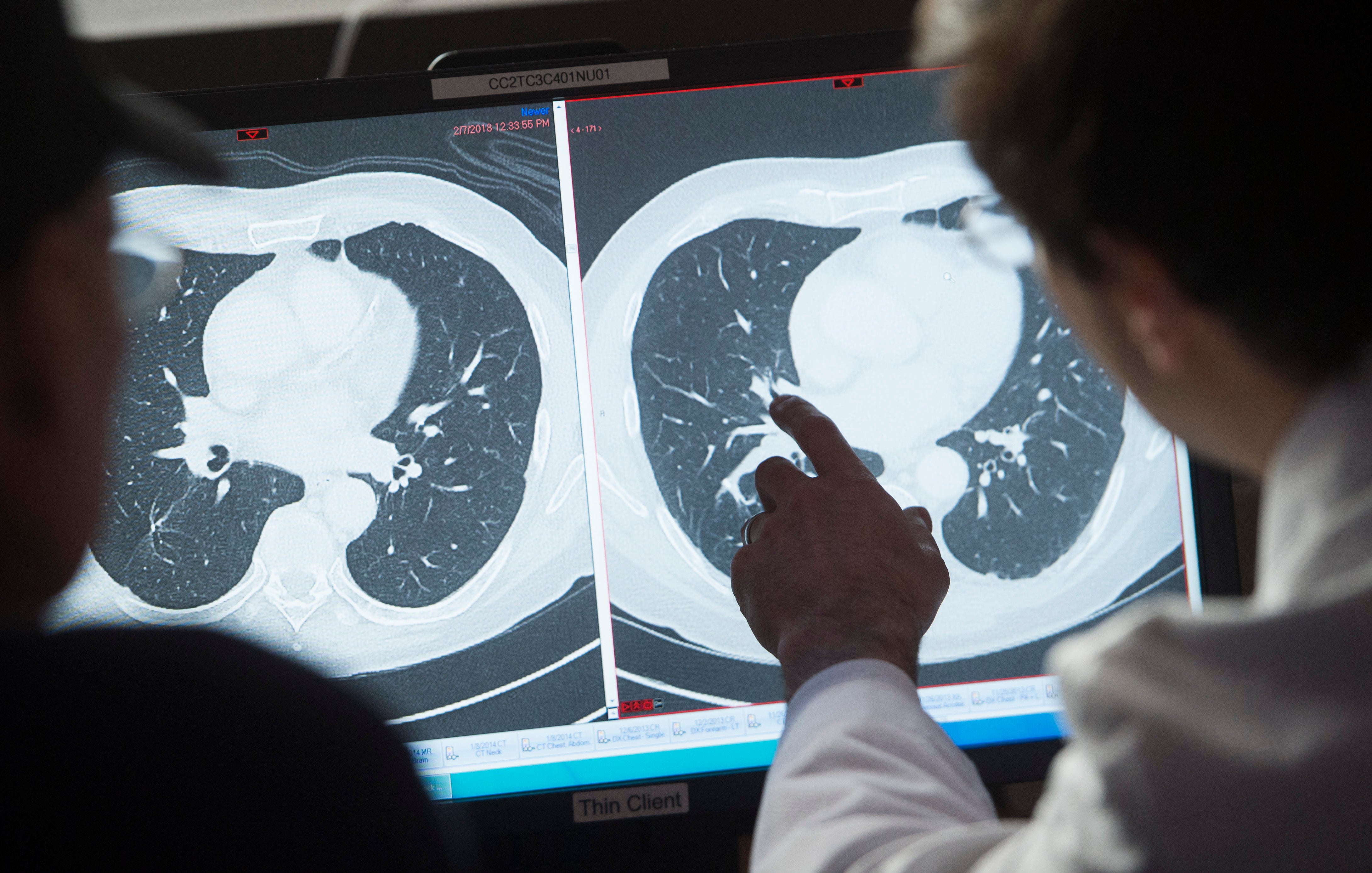 CT scans are commonly used in lung and colon cancer screening. But, even low-dose CTs carry risk