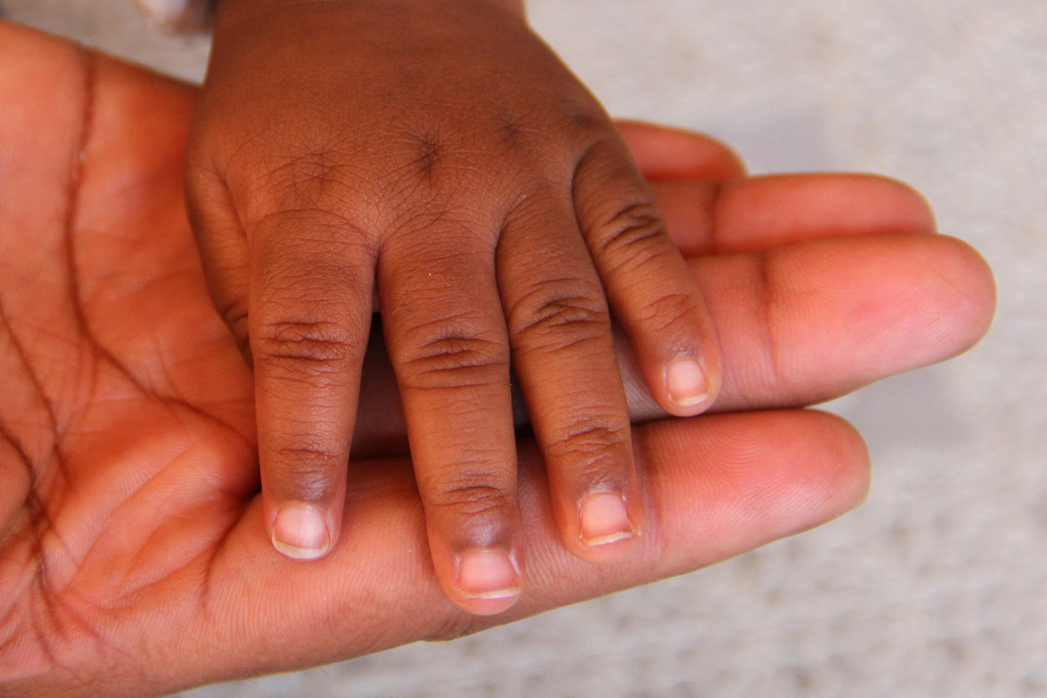 Prematurity is the single biggest killer of children identified by the WHO data (Alamy/PA)