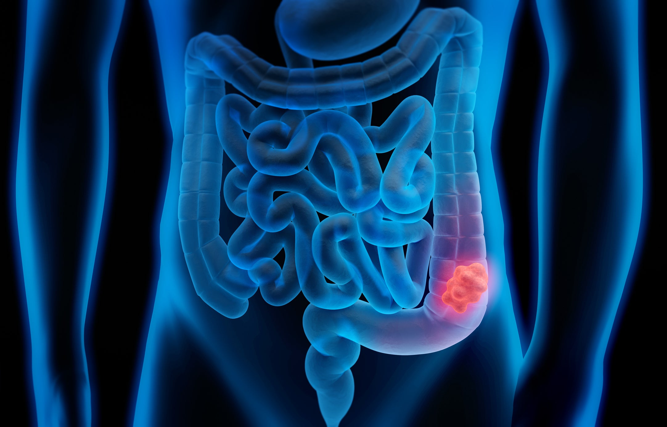 Monitoring polyps that grow in the colon and rectum could help prevent colorectal cancer, experts say. Screening should start at age 45 or earlier
