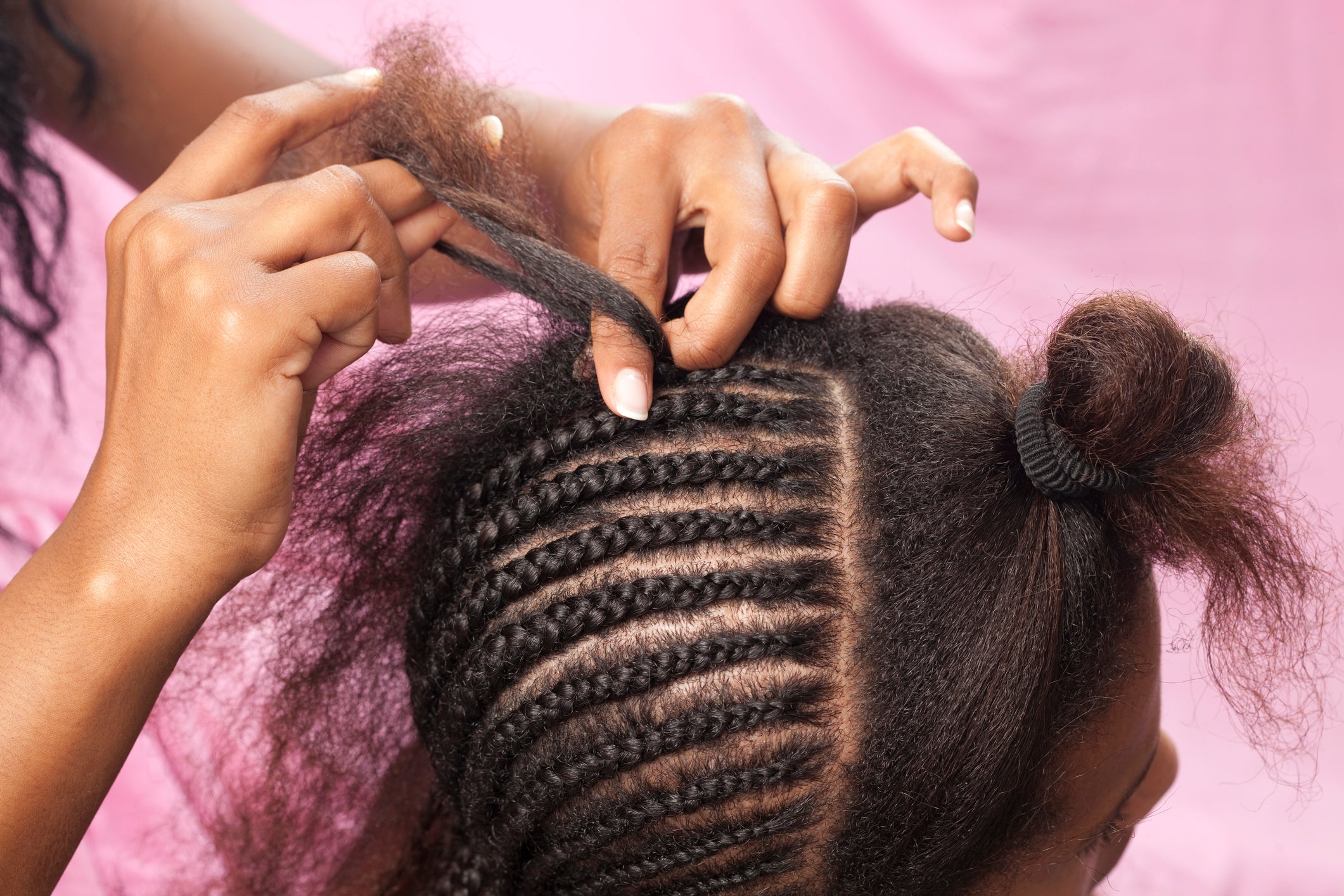 Tight braids can cause traction alopecia