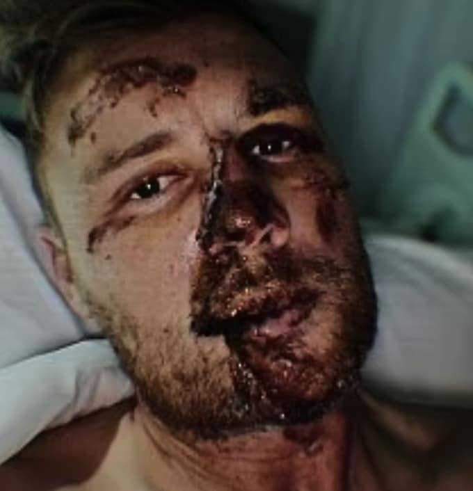 The sportsman was left with significant facial injuries after the front wheel came off his car during a drive