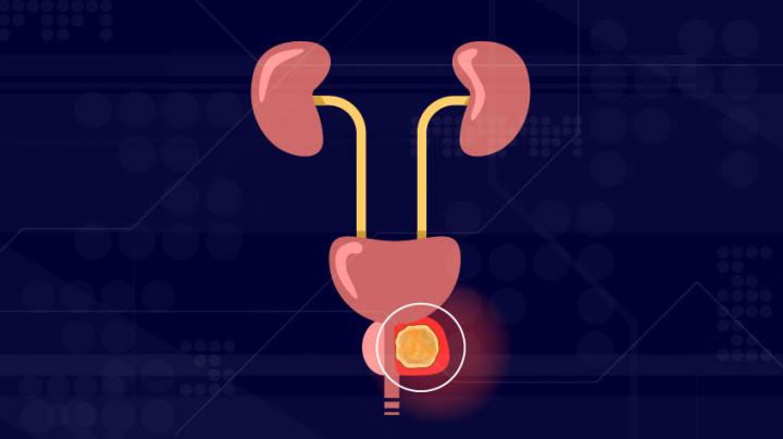 Illustration of prostate cancer