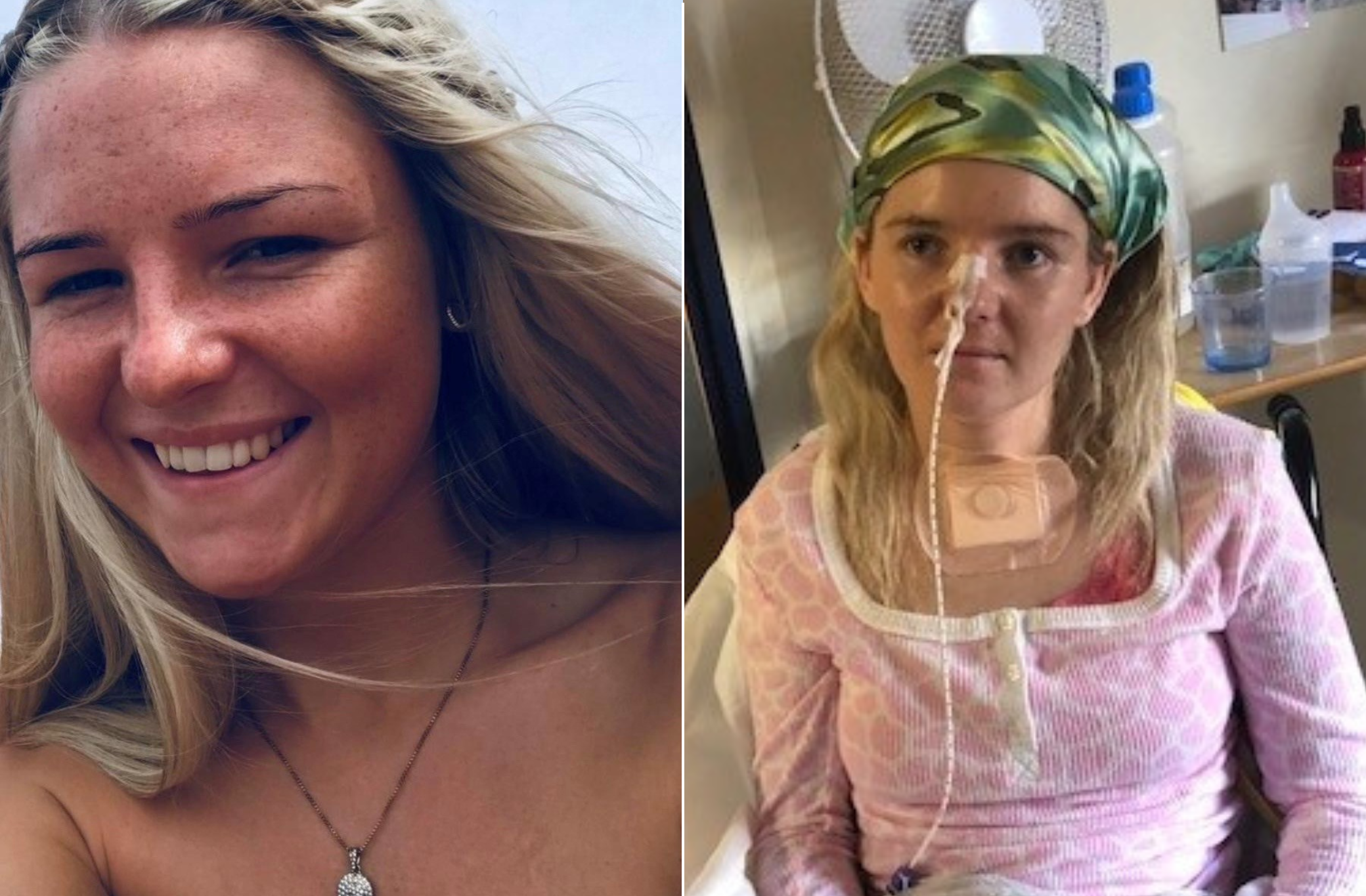 Summer Clarke suffered from a stroke at 24-years-old after a spontaneous brain haemorrhage