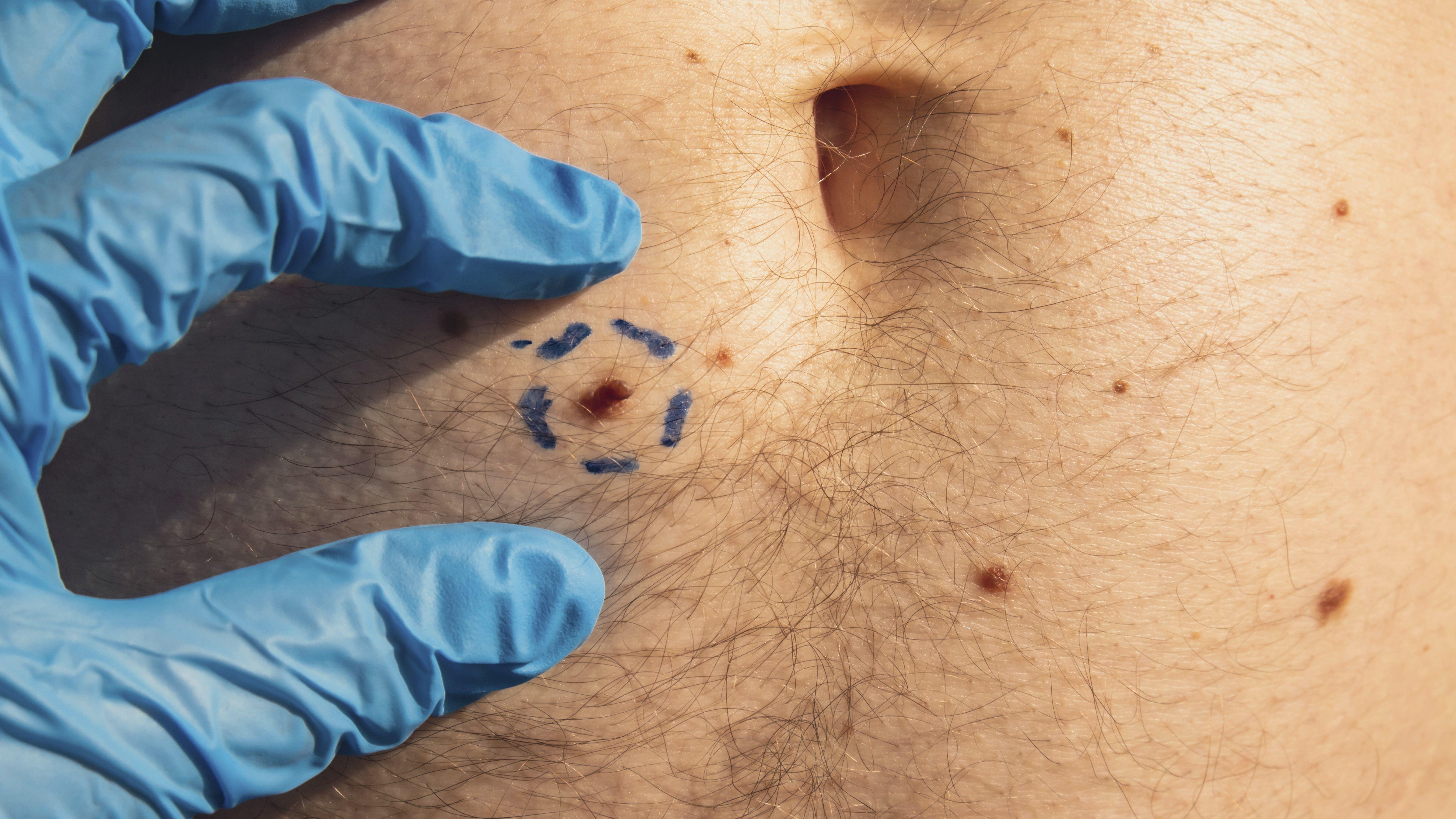 Advanced melanoma, also known as stage four melanoma, means the disease has spread to other parts of the body