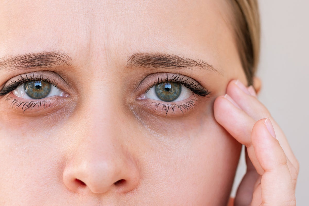 What is ‘ferritin face’ – and can my skin really show the signs of low iron? What is ‘ferritin face’ – and can my skin really show the signs of low iron?