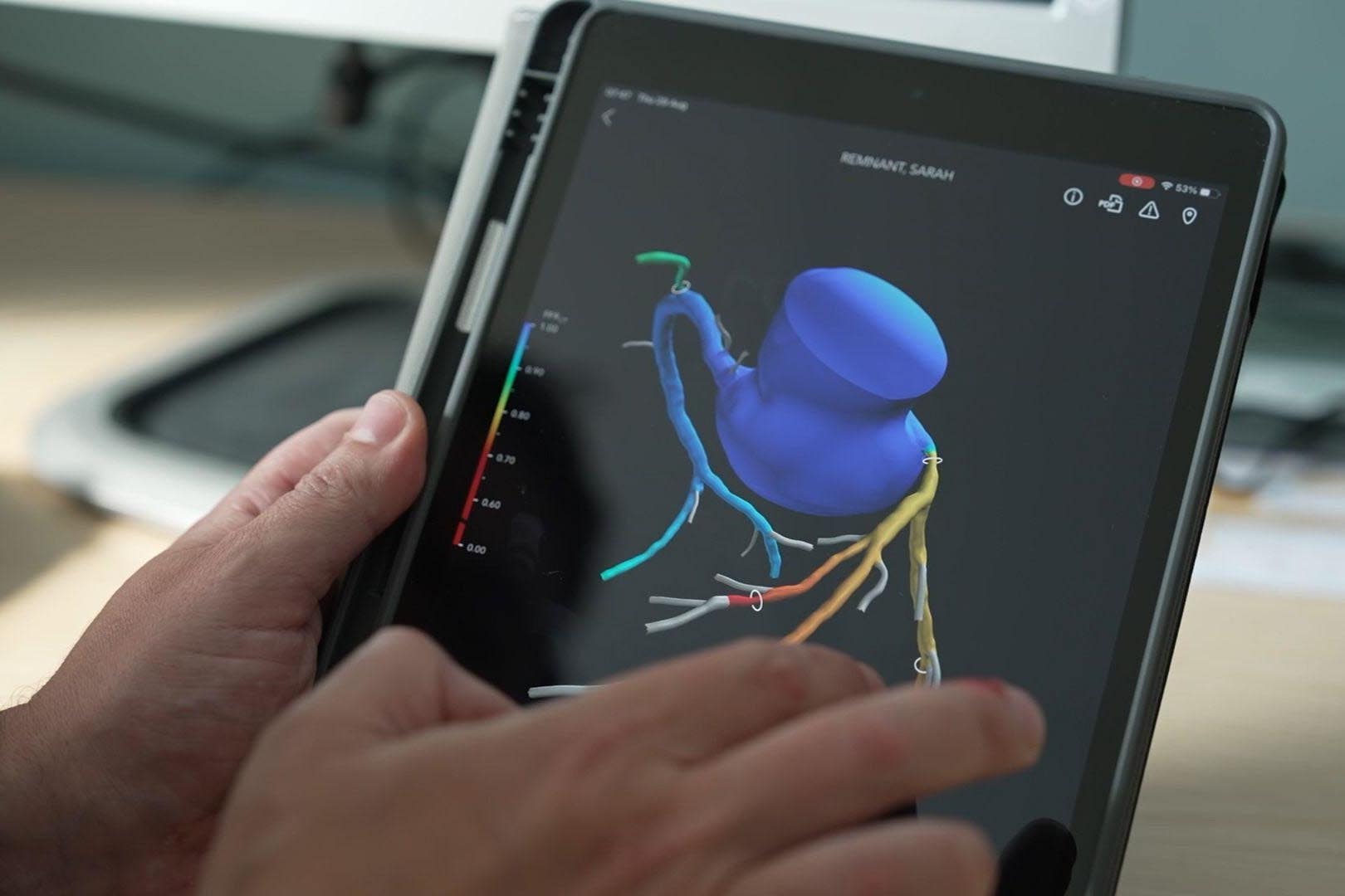 A heart flow scan of a coronary heart disease sufferer Sarah Remnant (NHS England/PA)