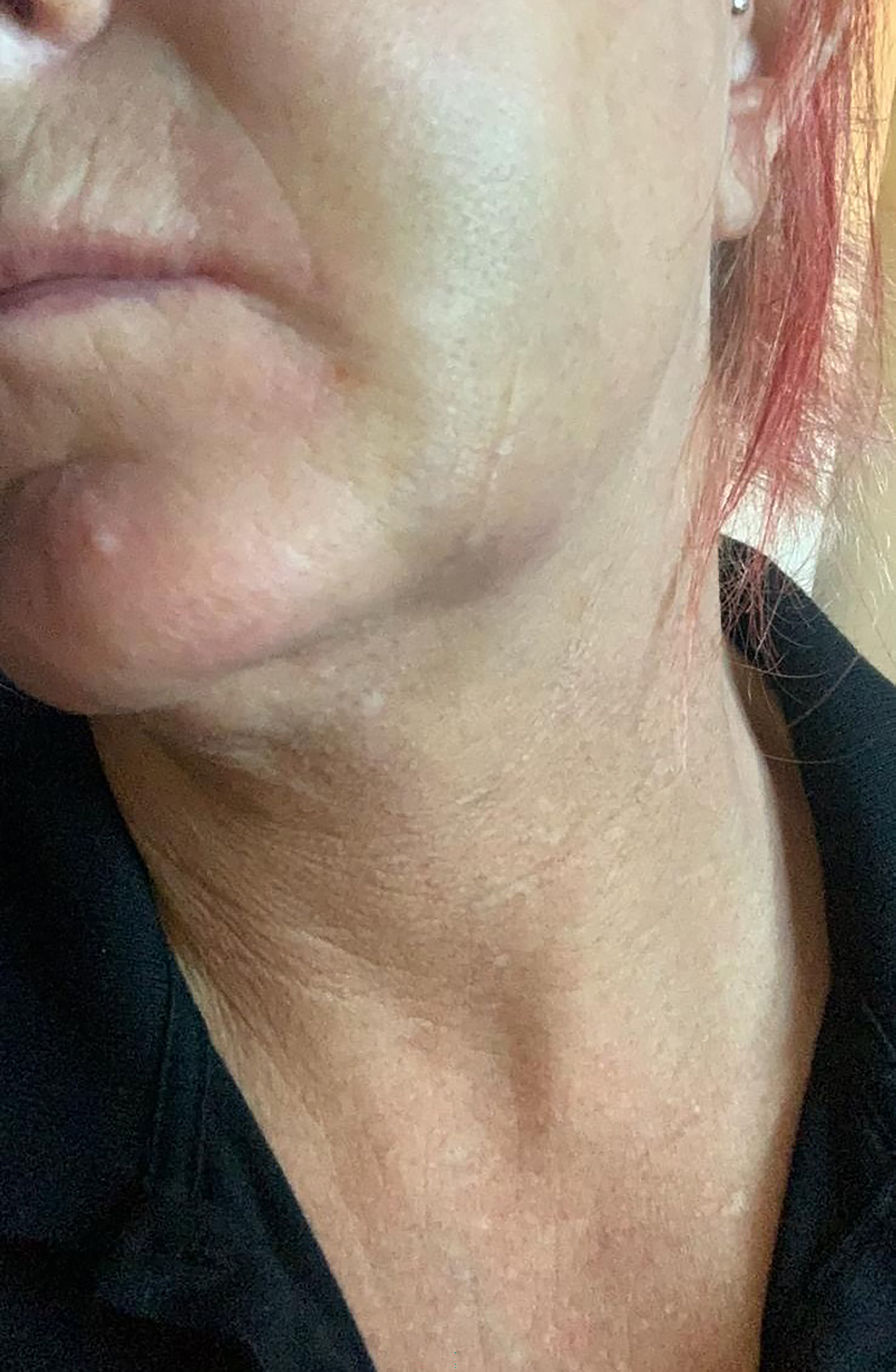 Hematomas na mandíbula em Sra. Starling após o acidente