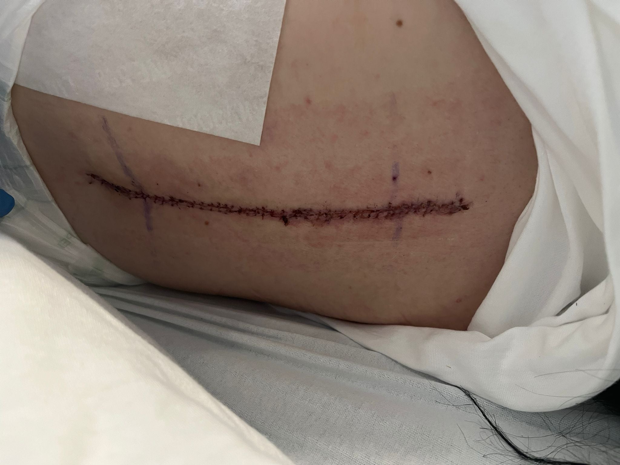 The scar on Julie's back after her operation