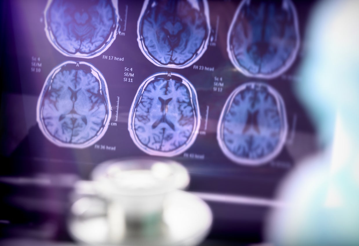 The study revealed that individuals with a history of HSV-1 infection had an 80 per cent increased risk of developing Alzheimer's