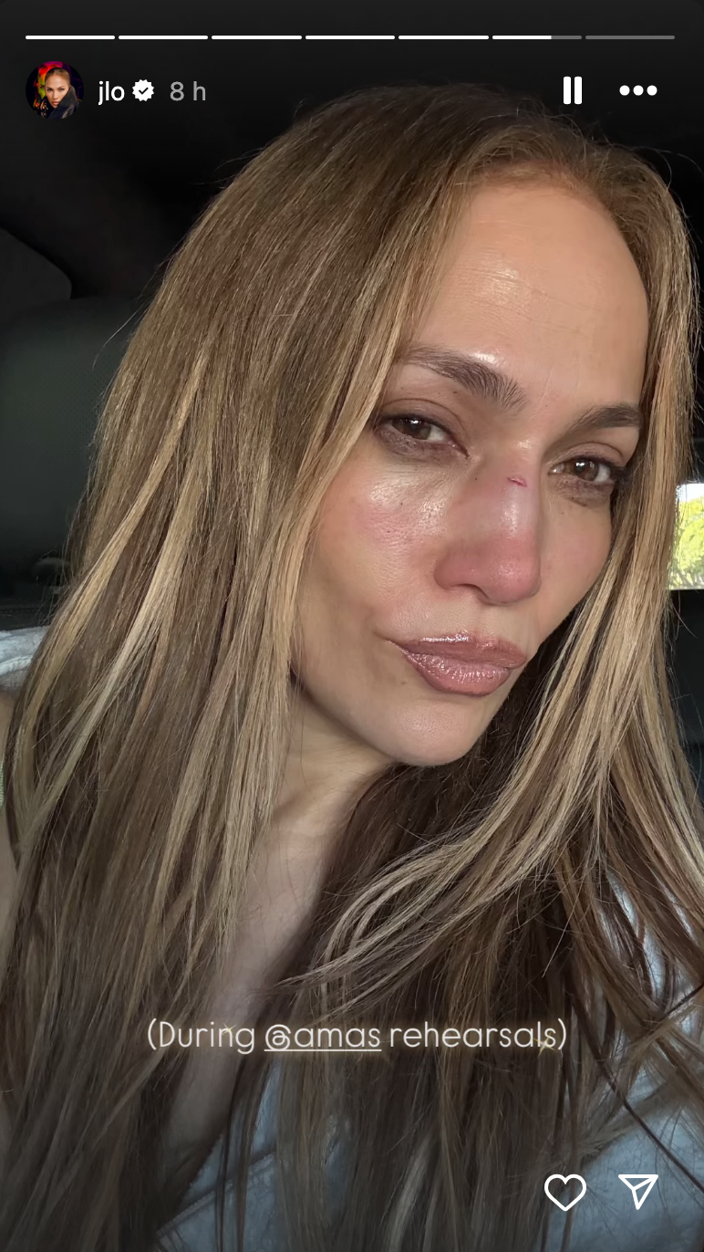 Jennifer Lopez revealed a large gash on her nose from rehearsals for the American Music Awards