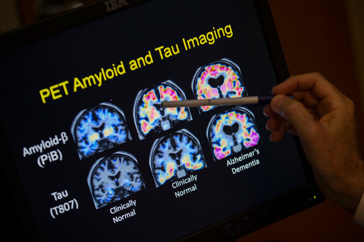 Thousands of NHS patients ‘to be denied breakthrough Alzheimer’s drugs’