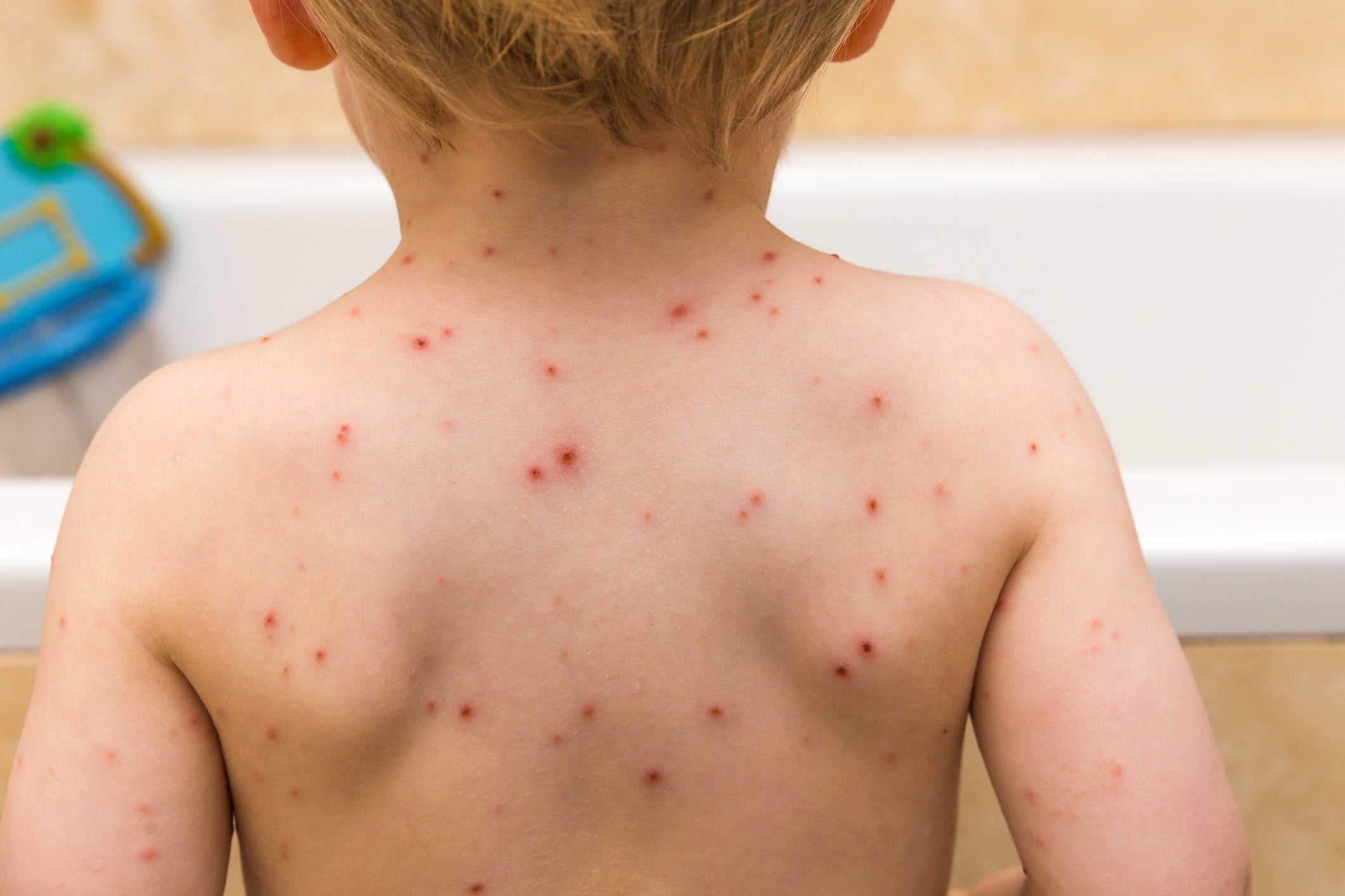 Chickenpox can cause severe complications
