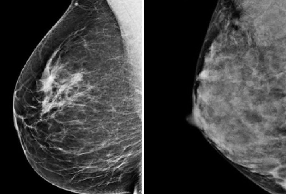 Example mammogram images of healthy breasts showing fatty/least dense (left) and dense (right)