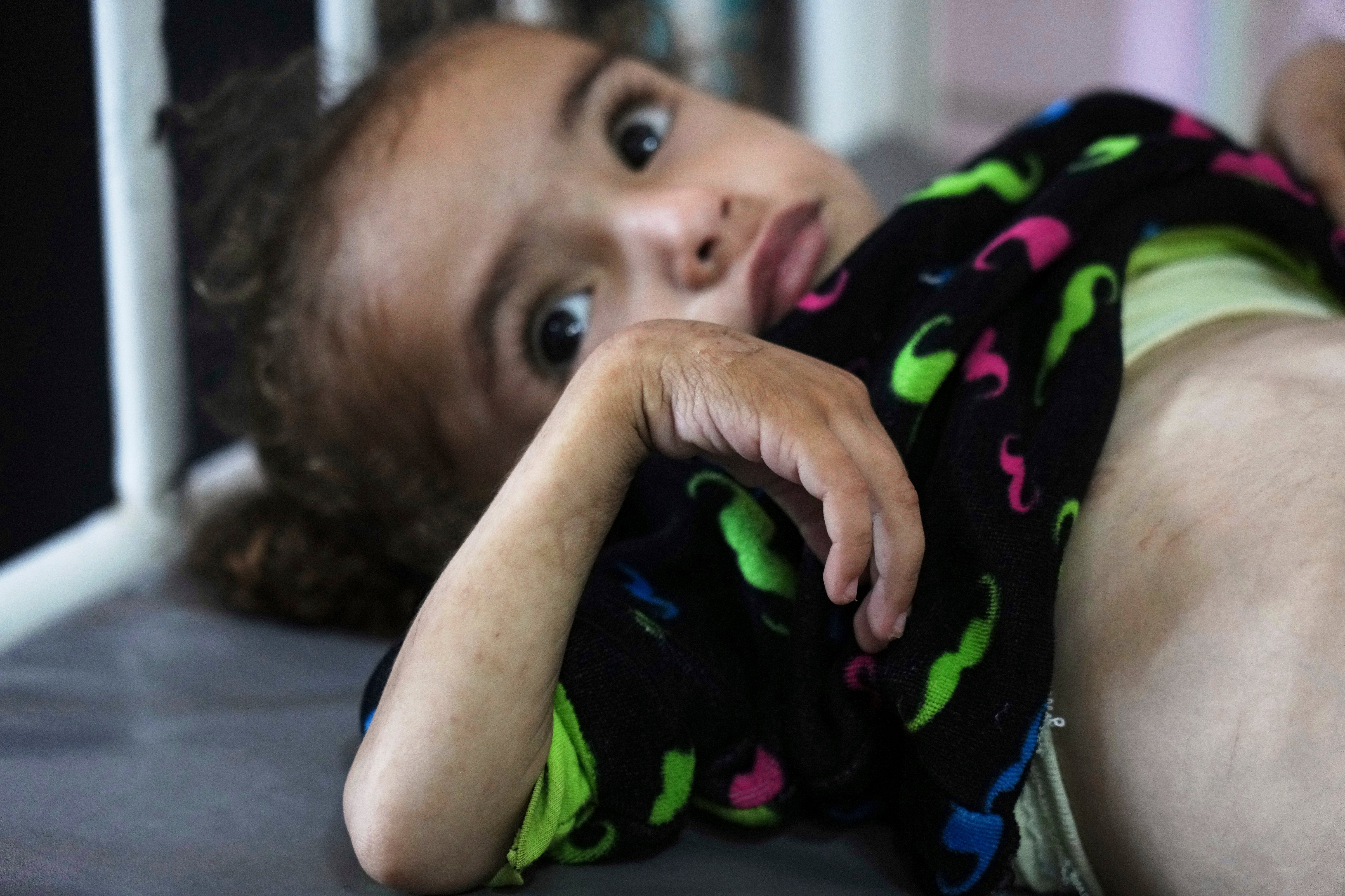 Mideast Wars Gaza Malnutrition